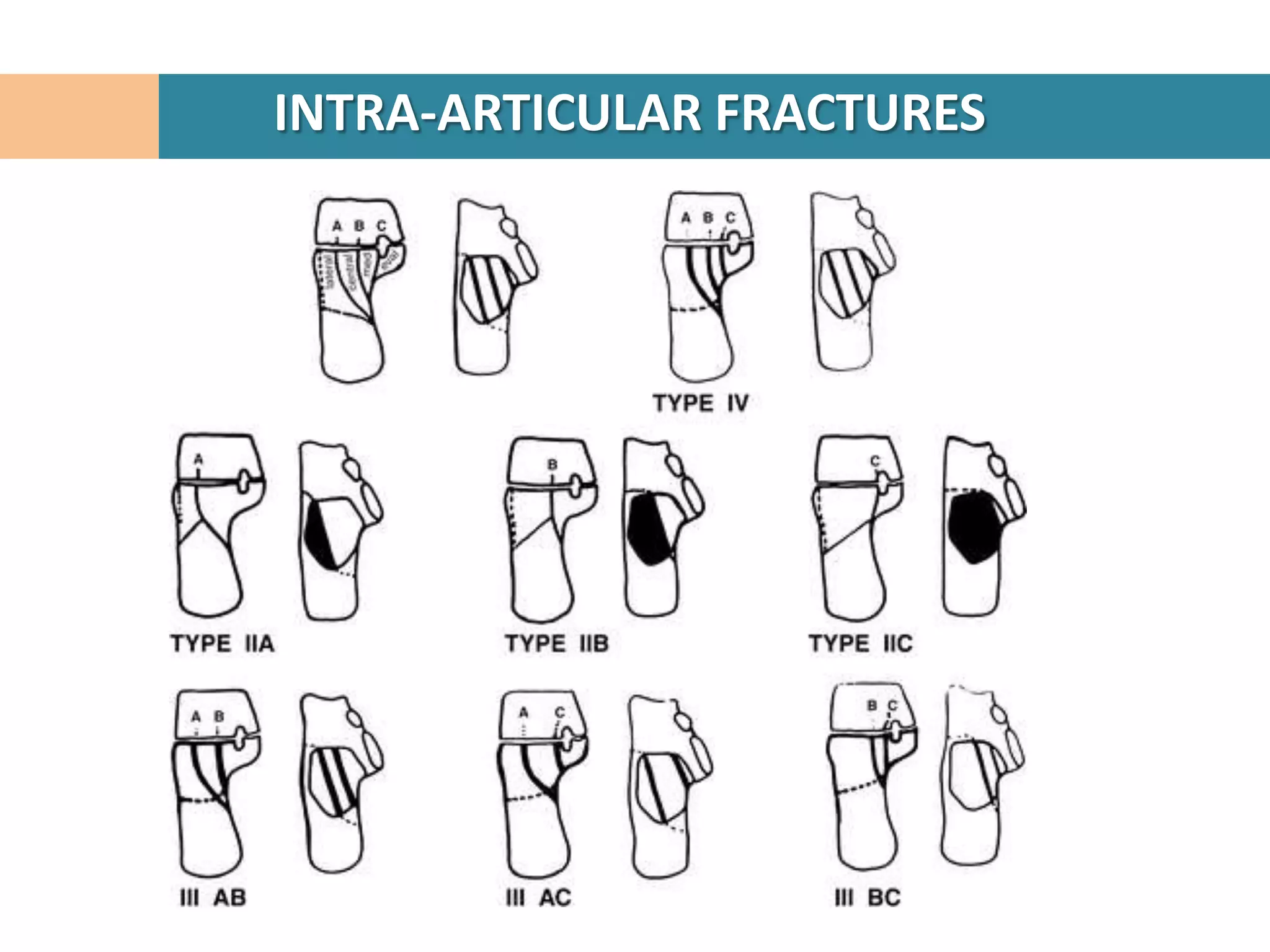INTRA-ARTICULAR FRACTURES
 