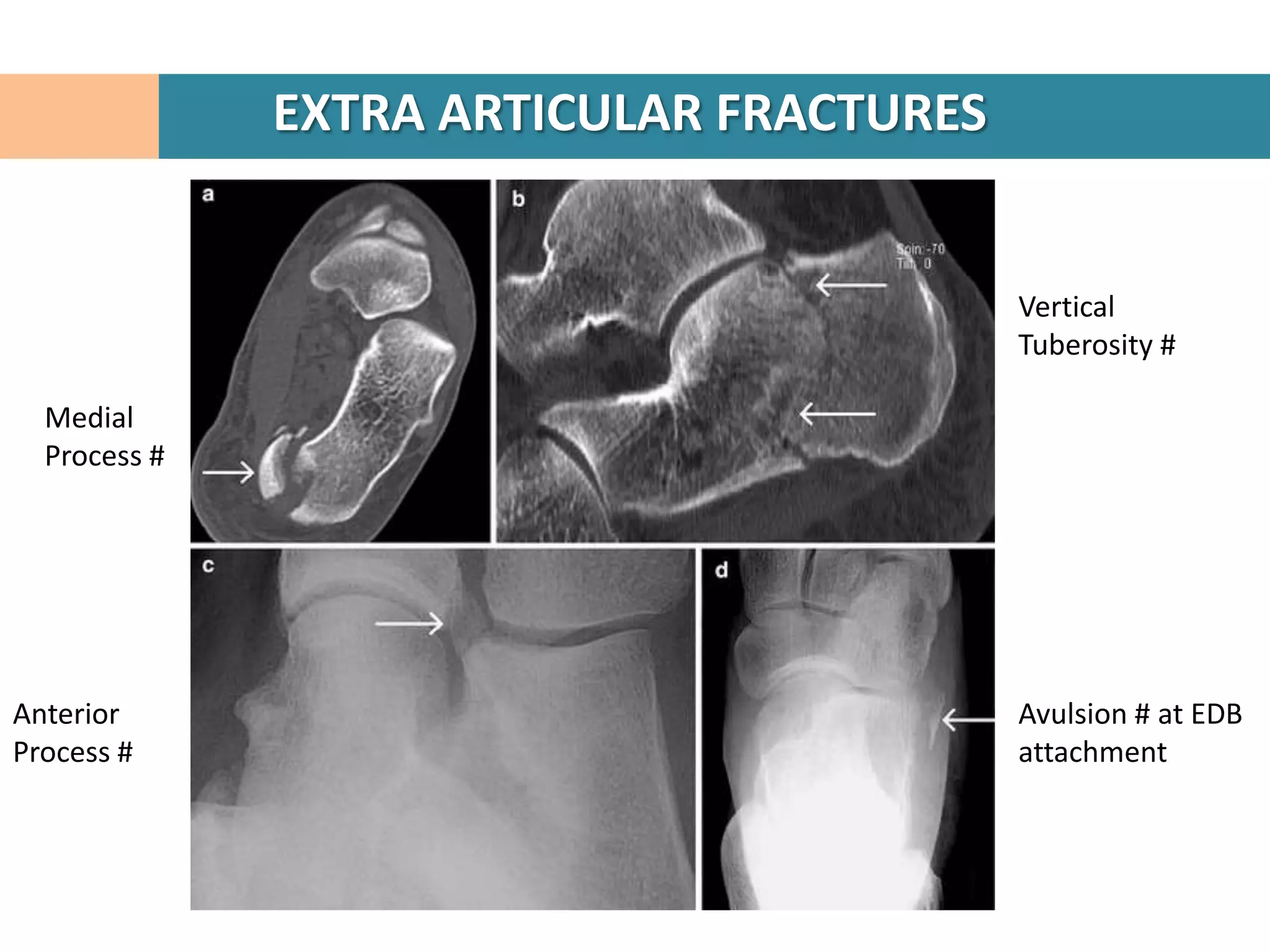EXTRA ARTICULAR FRACTURES


                                          Vertical
                                          Tuberosity #

  Medial
  Process #




Anterior                                  Avulsion # at EDB
Process #                                 attachment
 