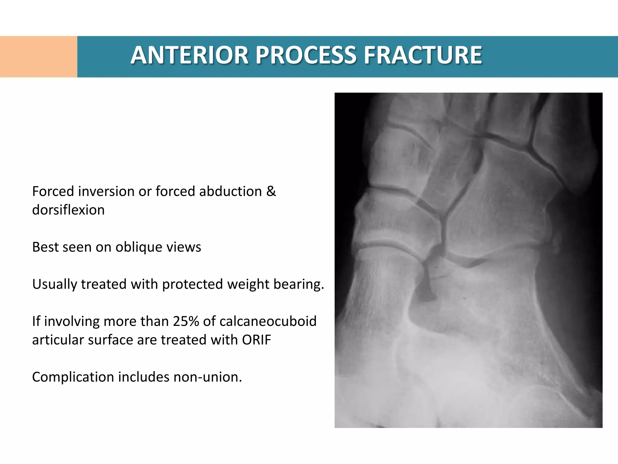 ANTERIOR PROCESS FRACTURE



Forced inversion or forced abduction &
dorsiflexion

Best seen on oblique views

Usually treated with protected weight bearing.

If involving more than 25% of calcaneocuboid
articular surface are treated with ORIF

Complication includes non-union.
 