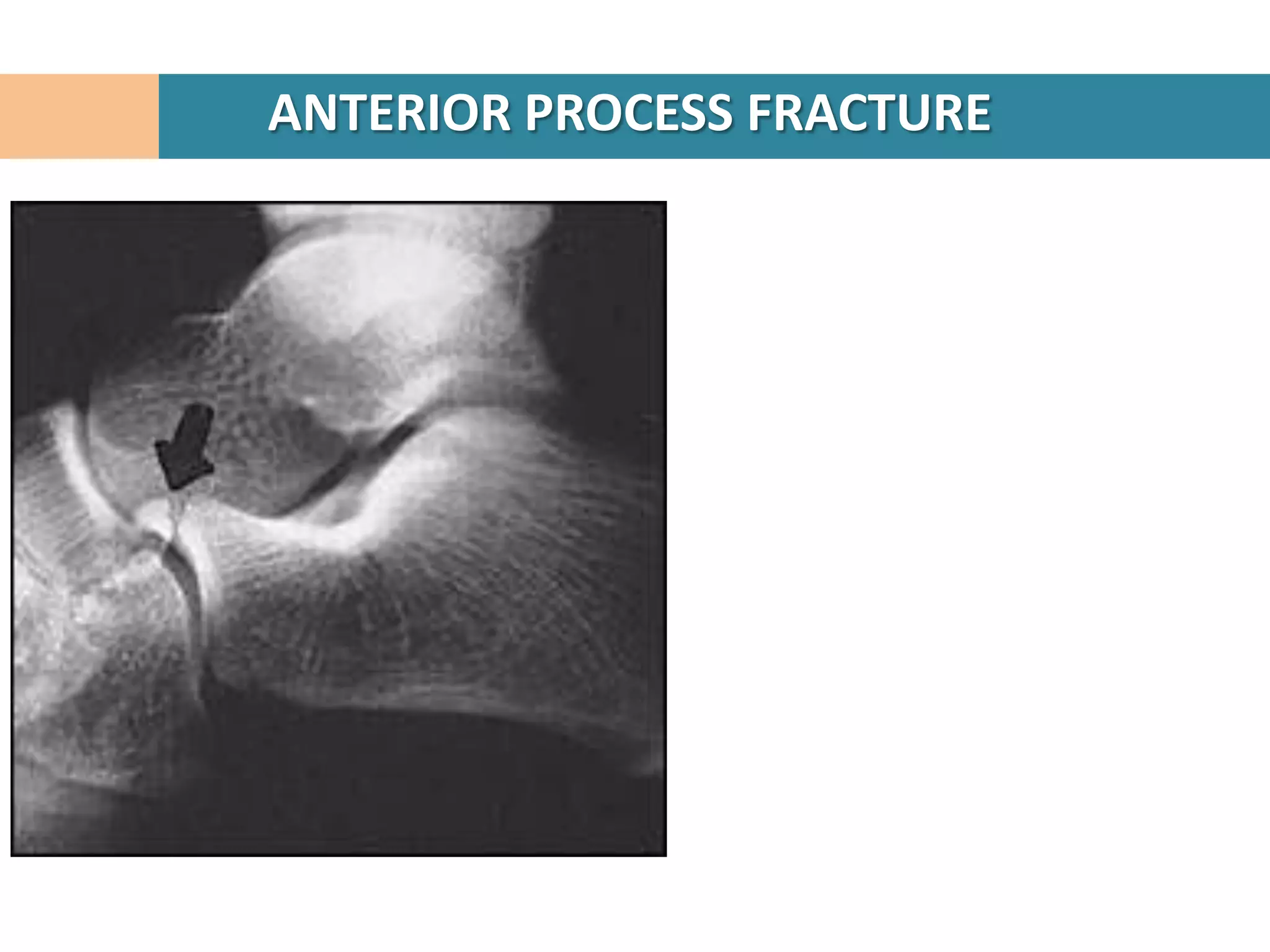 ANTERIOR PROCESS FRACTURE
 