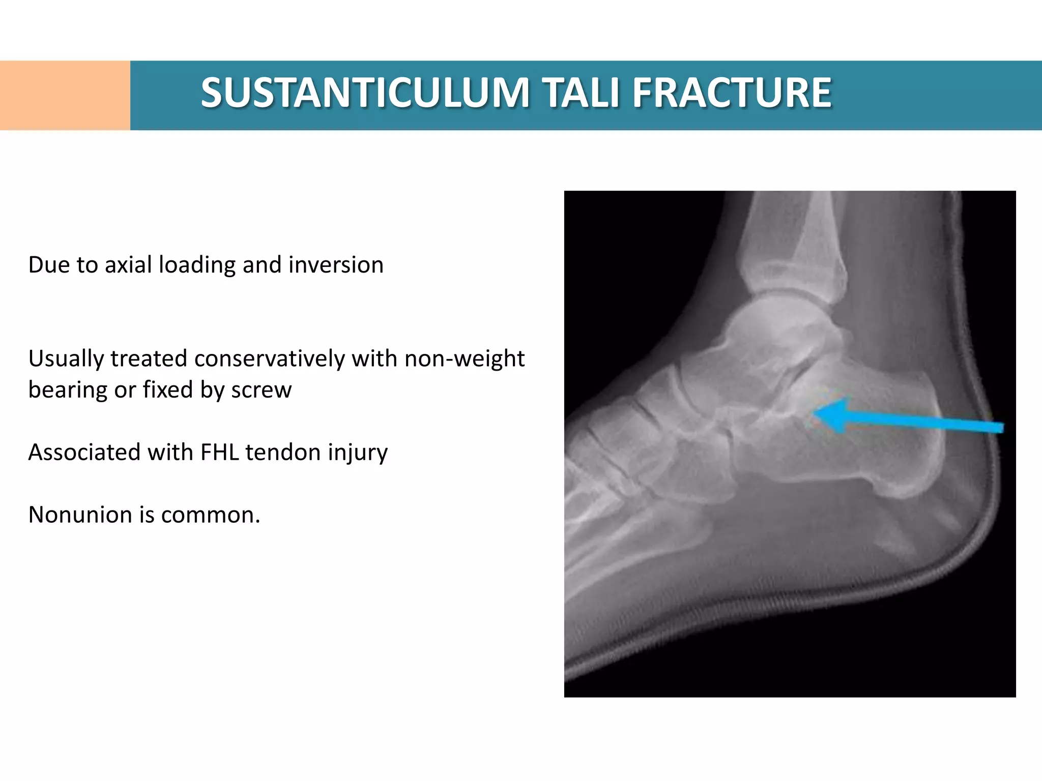 SUSTANTICULUM TALI FRACTURE


Due to axial loading and inversion


Usually treated conservatively with non-weight
bearing or fixed by screw

Associated with FHL tendon injury

Nonunion is common.
 