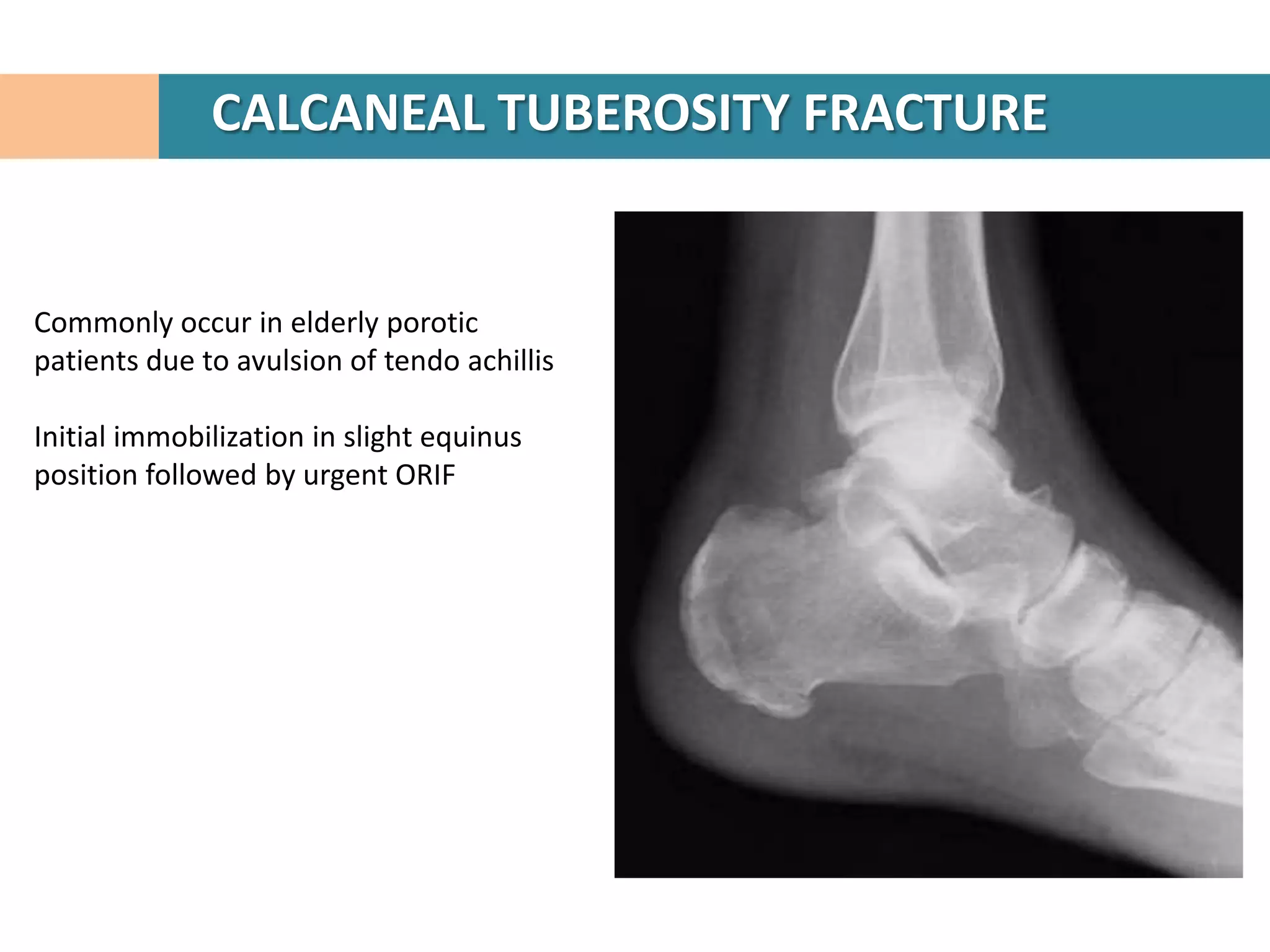 CALCANEAL TUBEROSITY FRACTURE


Commonly occur in elderly porotic
patients due to avulsion of tendo achillis

Initial immobilization in slight equinus
position followed by urgent ORIF
 