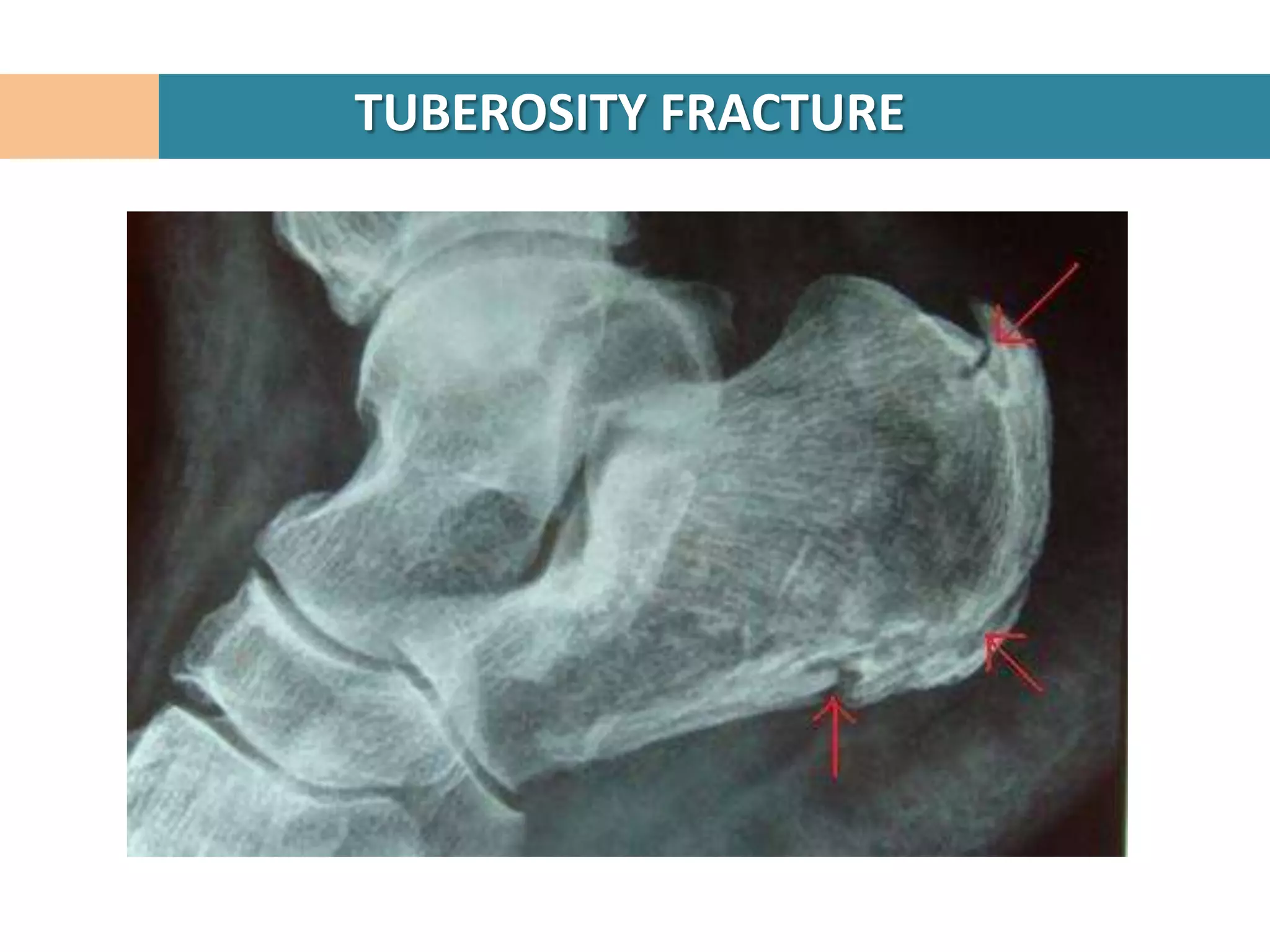 TUBEROSITY FRACTURE
 