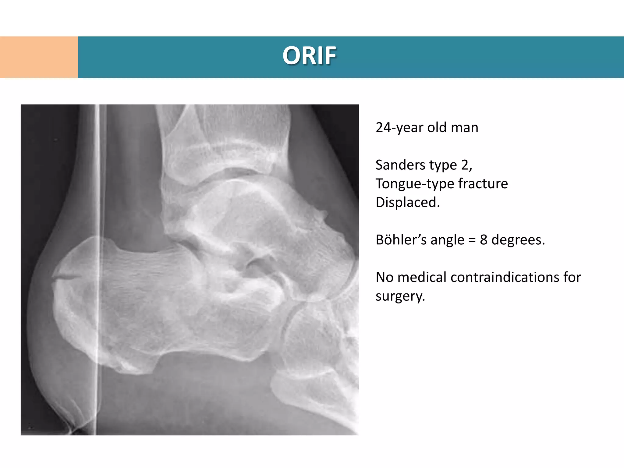 ORIF

       24-year old man

       Sanders type 2,
       Tongue-type fracture
       Displaced.

       Böhler’s angle = 8 degrees.

       No medical contraindications for
       surgery.
 