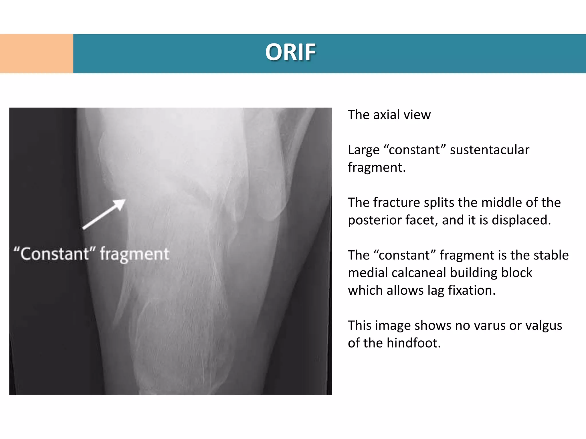 ORIF

       The axial view

       Large “constant” sustentacular
       fragment.

       The fracture splits the middle of the
       posterior facet, and it is displaced.

       The “constant” fragment is the stable
       medial calcaneal building block
       which allows lag fixation.

       This image shows no varus or valgus
       of the hindfoot.
 