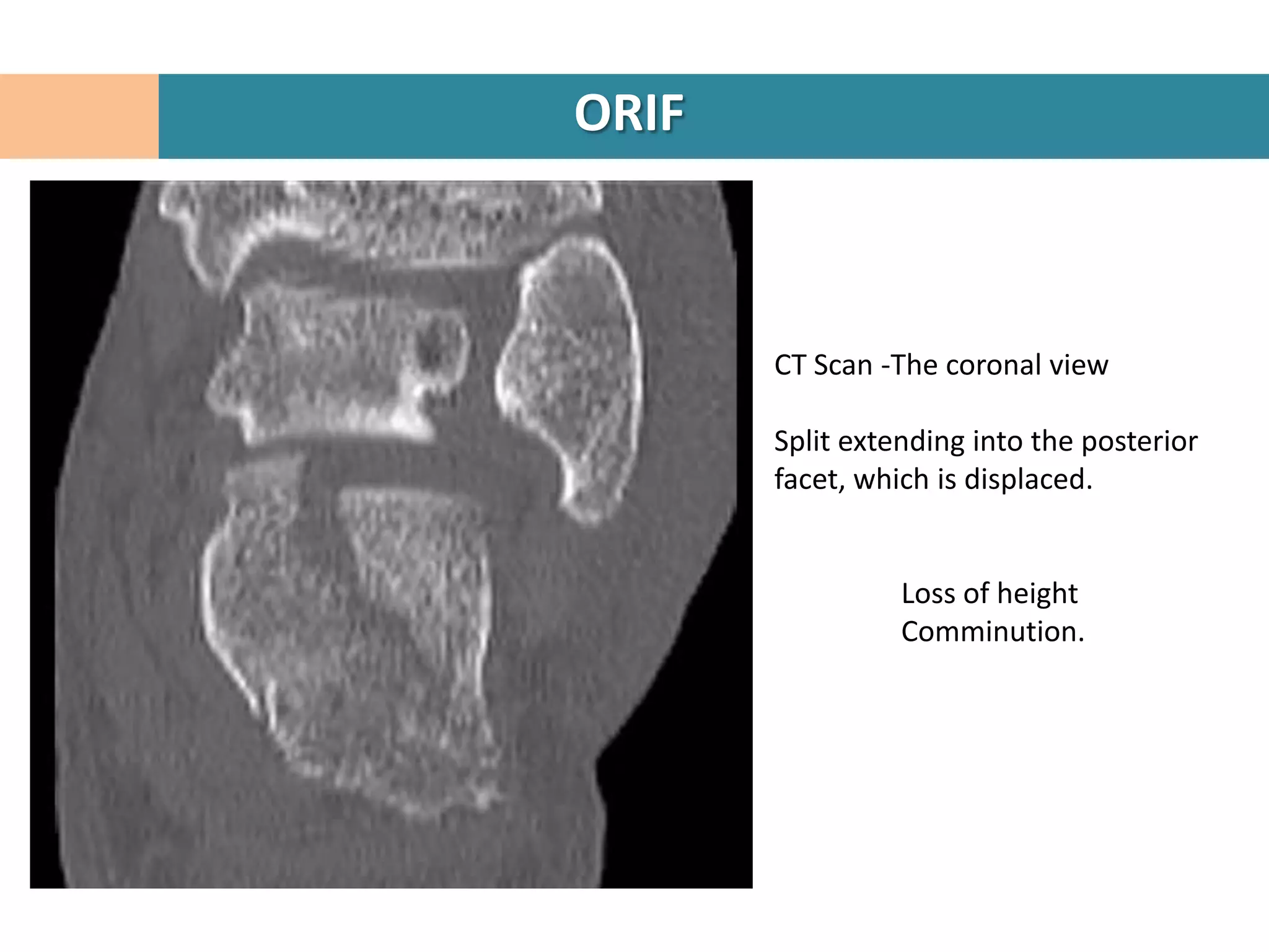 ORIF



       CT Scan -The coronal view

       Split extending into the posterior
       facet, which is displaced.


                 Loss of height
                 Comminution.
 