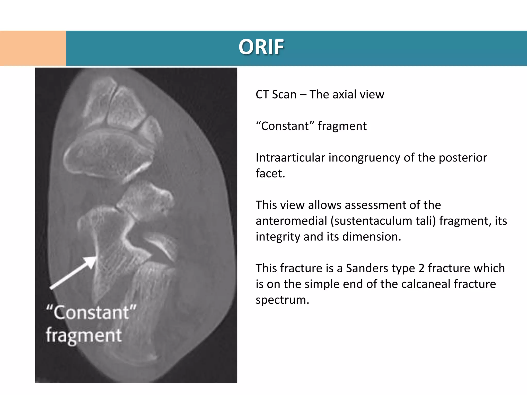 ORIF
 CT Scan – The axial view

 “Constant” fragment

 Intraarticular incongruency of the posterior
 facet.

 This view allows assessment of the
 anteromedial (sustentaculum tali) fragment, its
 integrity and its dimension.

 This fracture is a Sanders type 2 fracture which
 is on the simple end of the calcaneal fracture
 spectrum.
 