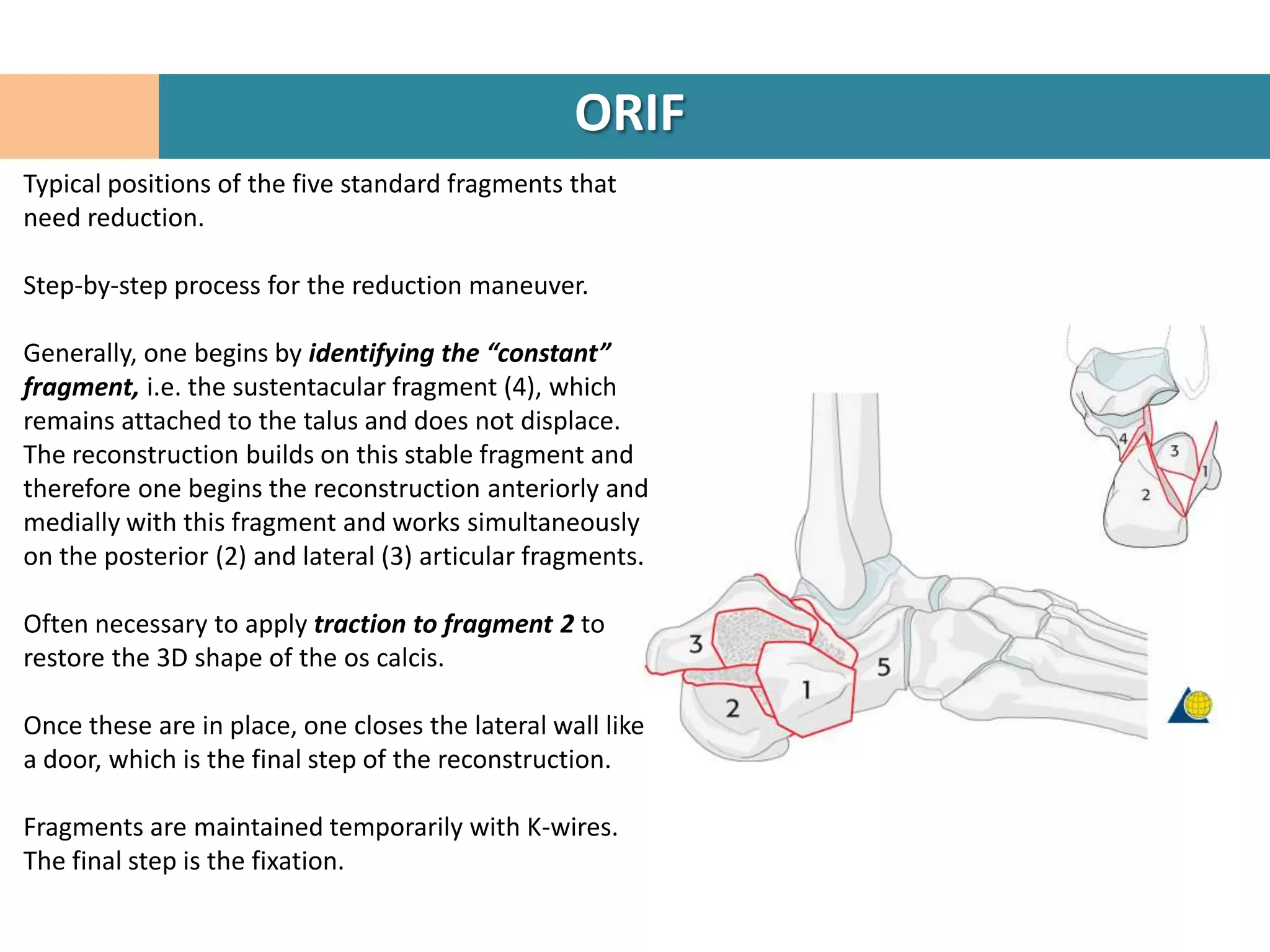 ORIF
Typical positions of the five standard fragments that
need reduction.

Step-by-step process for the reduction maneuver.

Generally, one begins by identifying the “constant”
fragment, i.e. the sustentacular fragment (4), which
remains attached to the talus and does not displace.
The reconstruction builds on this stable fragment and
therefore one begins the reconstruction anteriorly and
medially with this fragment and works simultaneously
on the posterior (2) and lateral (3) articular fragments.

Often necessary to apply traction to fragment 2 to
restore the 3D shape of the os calcis.

Once these are in place, one closes the lateral wall like
a door, which is the final step of the reconstruction.

Fragments are maintained temporarily with K-wires.
The final step is the fixation.
 