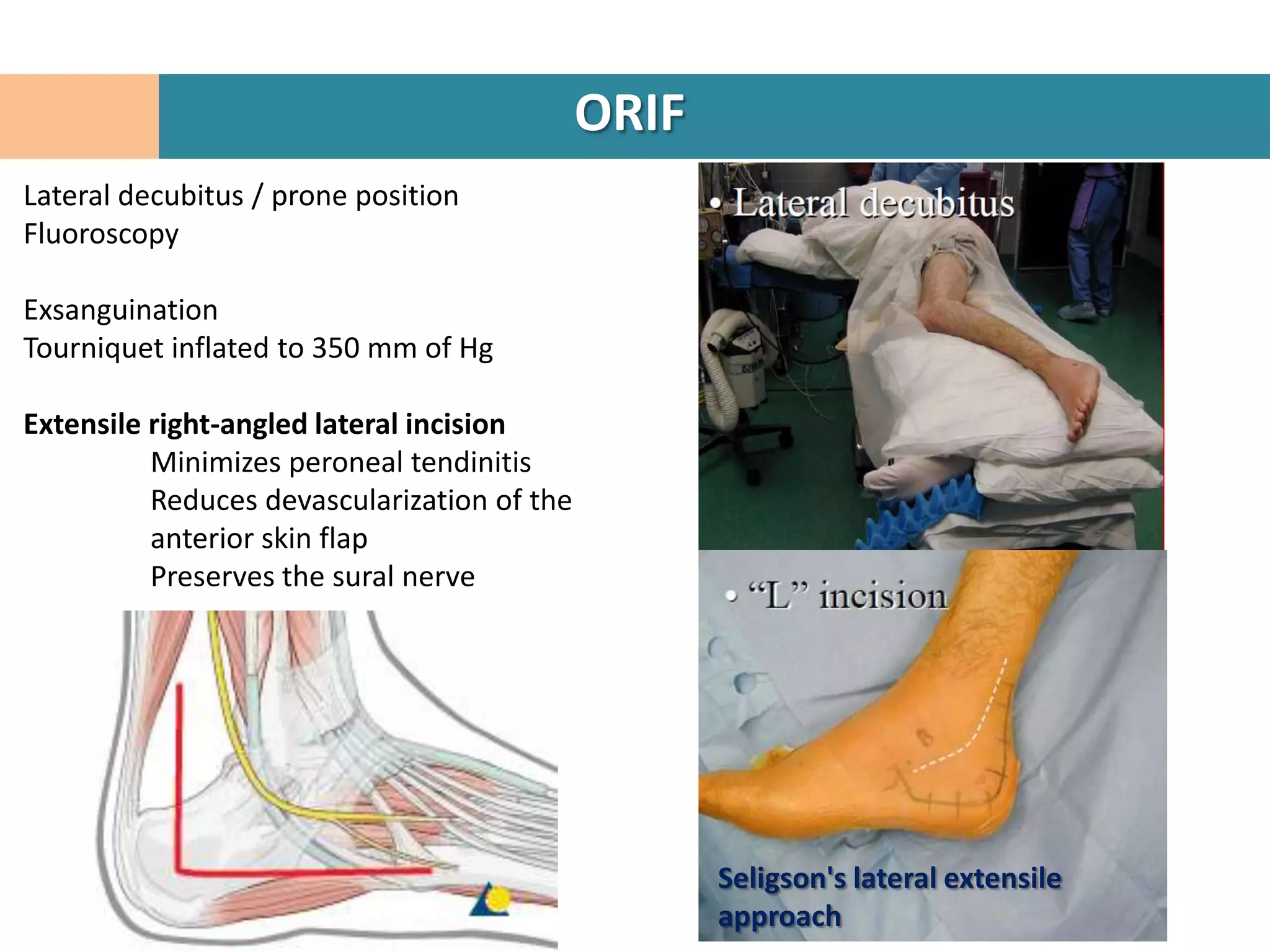 ORIF
Lateral decubitus / prone position
Fluoroscopy

Exsanguination
Tourniquet inflated to 350 mm of Hg

Extensile right-angled lateral incision
          Minimizes peroneal tendinitis
          Reduces devascularization of the
          anterior skin flap
          Preserves the sural nerve




                                                    Seligson's lateral extensile
                                                    approach
 