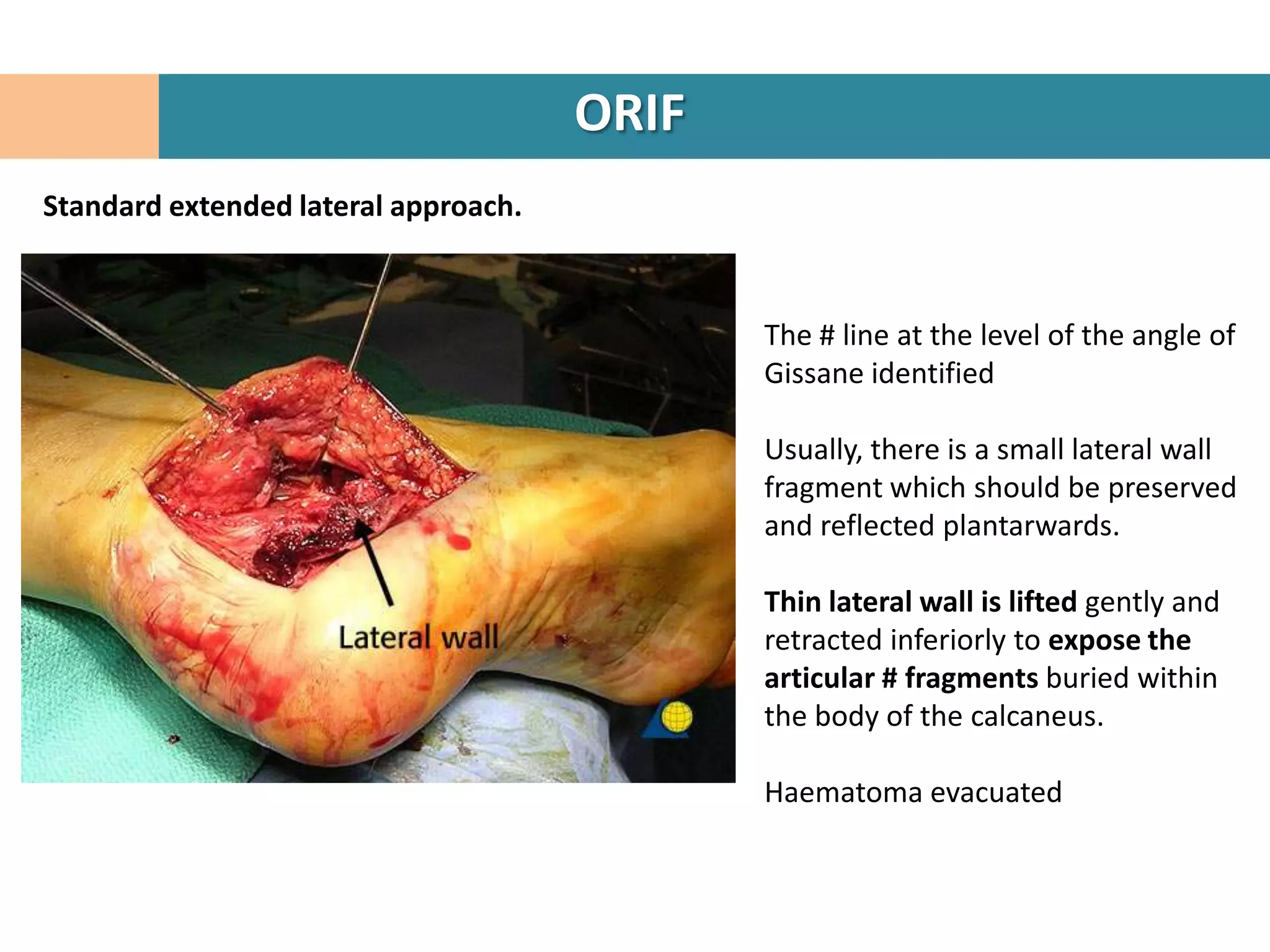 ORIF
Standard extended lateral approach.



                                             The # line at the level of the angle of
                                             Gissane identified

                                             Usually, there is a small lateral wall
                                             fragment which should be preserved
                                             and reflected plantarwards.

                                             Thin lateral wall is lifted gently and
                                             retracted inferiorly to expose the
                                             articular # fragments buried within
                                             the body of the calcaneus.

                                             Haematoma evacuated
 