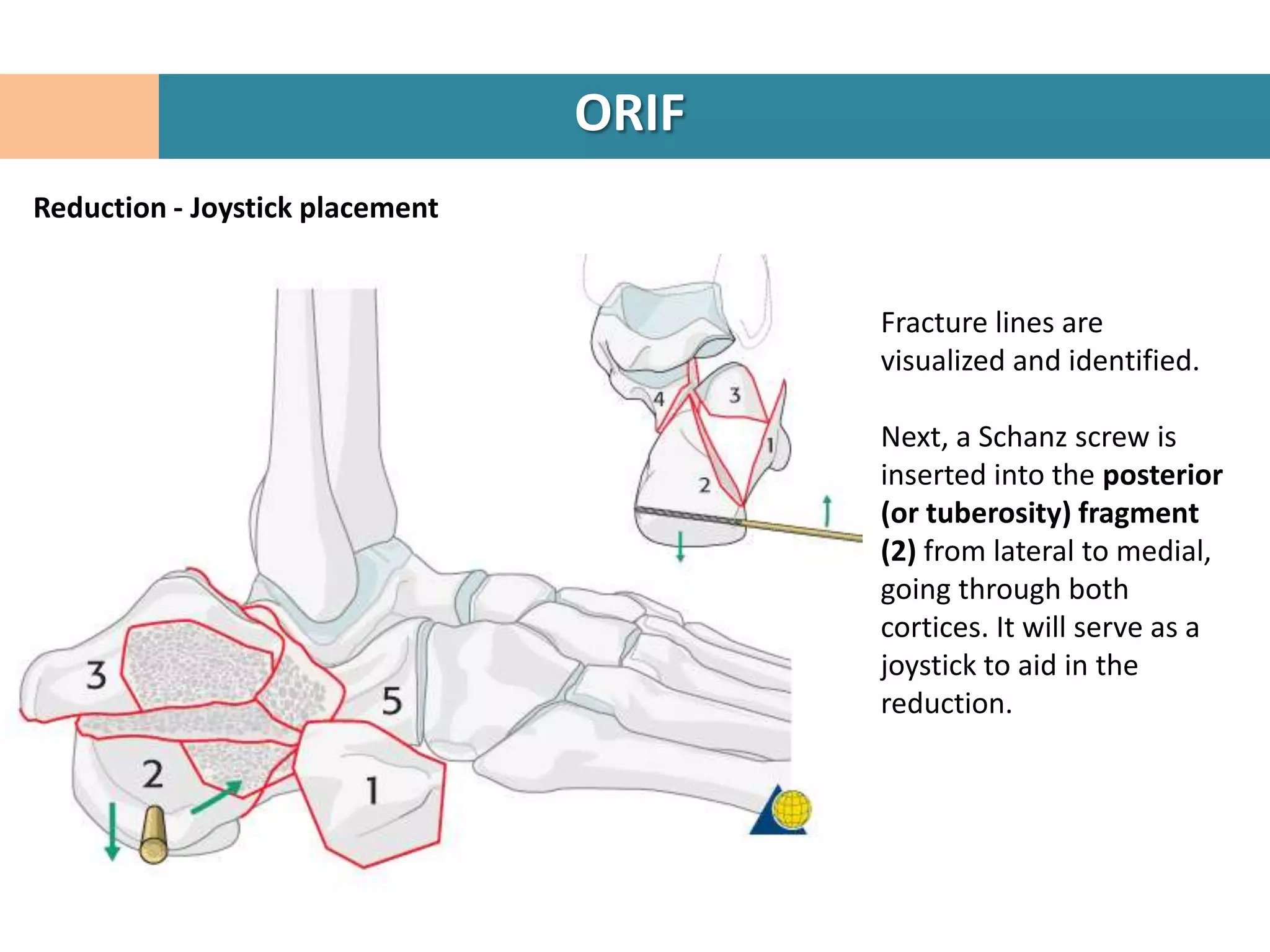 ORIF
Reduction - Joystick placement


                                        Fracture lines are
                                        visualized and identified.

                                        Next, a Schanz screw is
                                        inserted into the posterior
                                        (or tuberosity) fragment
                                        (2) from lateral to medial,
                                        going through both
                                        cortices. It will serve as a
                                        joystick to aid in the
                                        reduction.
 