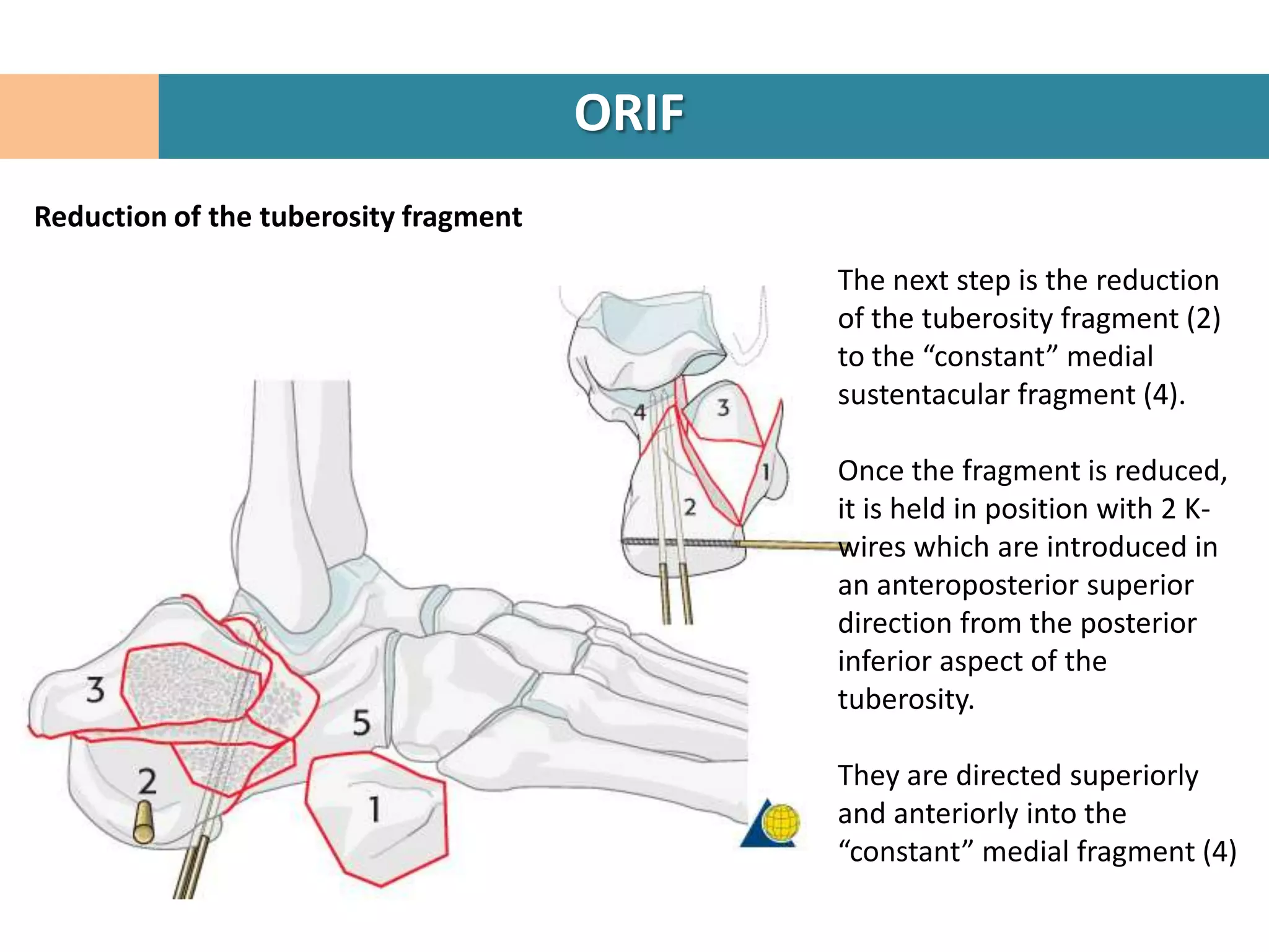 ORIF
Reduction of the tuberosity fragment

                                              The next step is the reduction
                                              of the tuberosity fragment (2)
                                              to the “constant” medial
                                              sustentacular fragment (4).

                                              Once the fragment is reduced,
                                              it is held in position with 2 K-
                                              wires which are introduced in
                                              an anteroposterior superior
                                              direction from the posterior
                                              inferior aspect of the
                                              tuberosity.

                                              They are directed superiorly
                                              and anteriorly into the
                                              “constant” medial fragment (4)
 