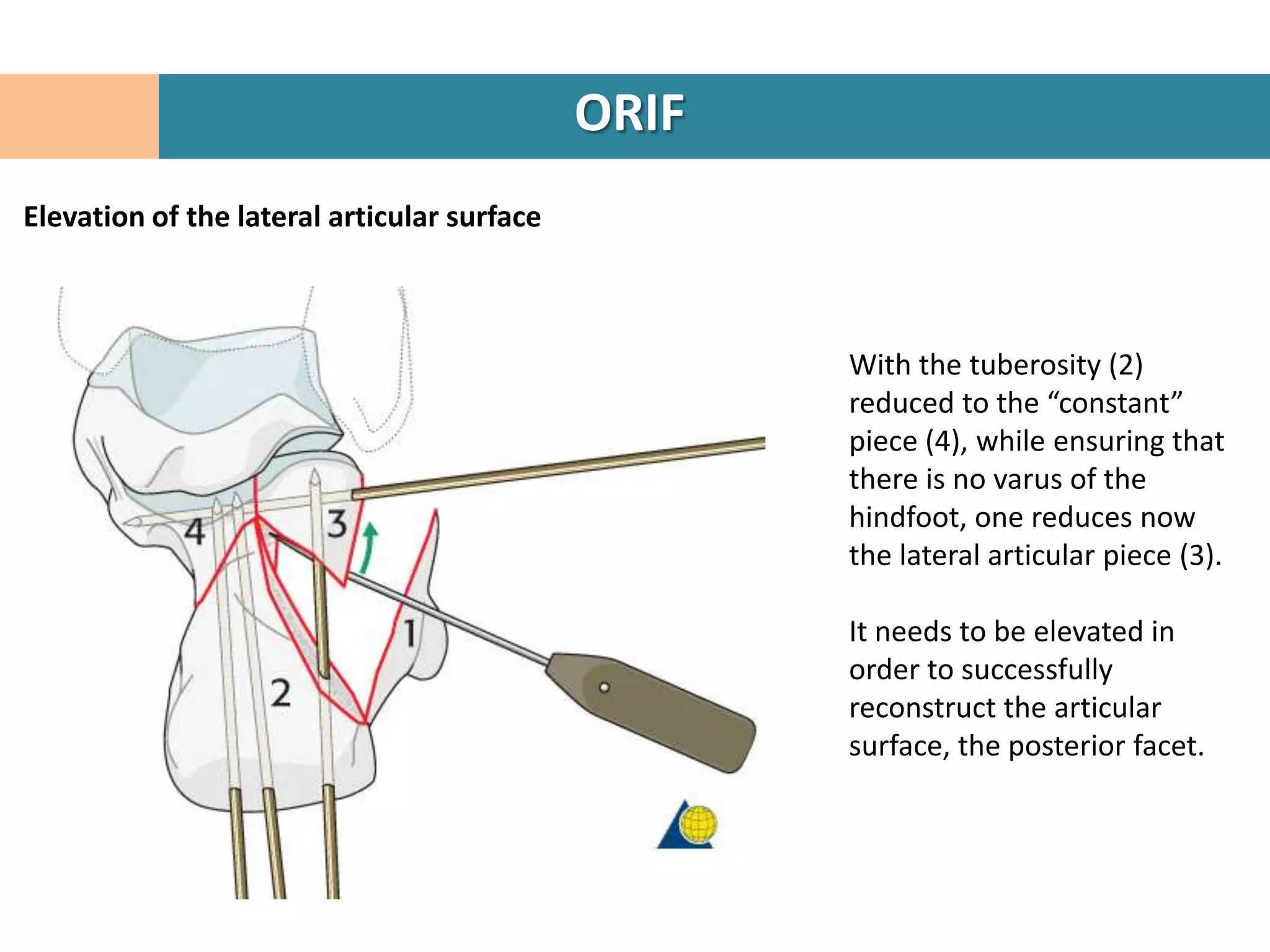 ORIF
Elevation of the lateral articular surface



                                                    With the tuberosity (2)
                                                    reduced to the “constant”
                                                    piece (4), while ensuring that
                                                    there is no varus of the
                                                    hindfoot, one reduces now
                                                    the lateral articular piece (3).

                                                    It needs to be elevated in
                                                    order to successfully
                                                    reconstruct the articular
                                                    surface, the posterior facet.
 