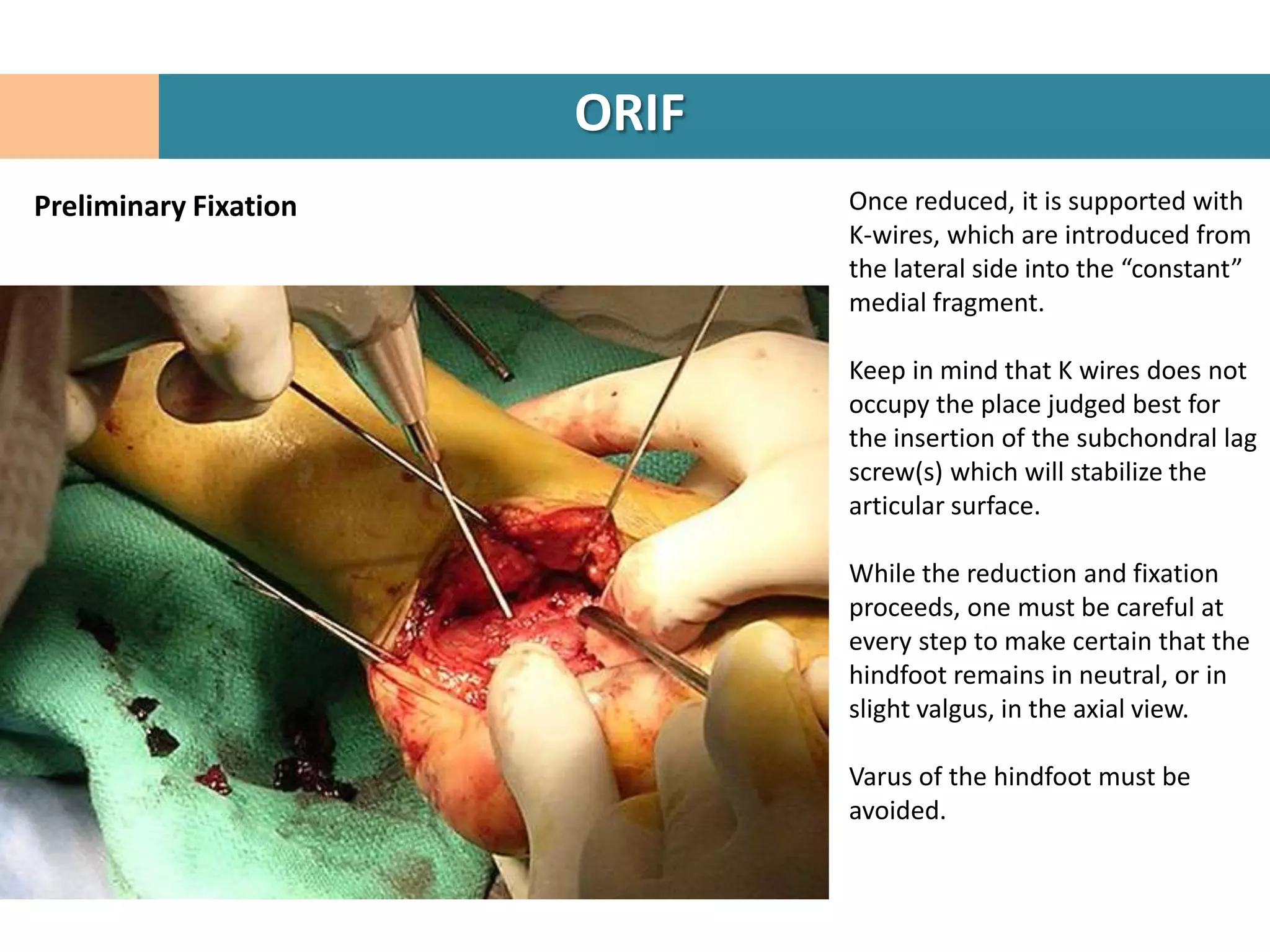 ORIF
Preliminary Fixation          Once reduced, it is supported with
                              K-wires, which are introduced from
                              the lateral side into the “constant”
                              medial fragment.

                              Keep in mind that K wires does not
                              occupy the place judged best for
                              the insertion of the subchondral lag
                              screw(s) which will stabilize the
                              articular surface.

                              While the reduction and fixation
                              proceeds, one must be careful at
                              every step to make certain that the
                              hindfoot remains in neutral, or in
                              slight valgus, in the axial view.

                              Varus of the hindfoot must be
                              avoided.
 
