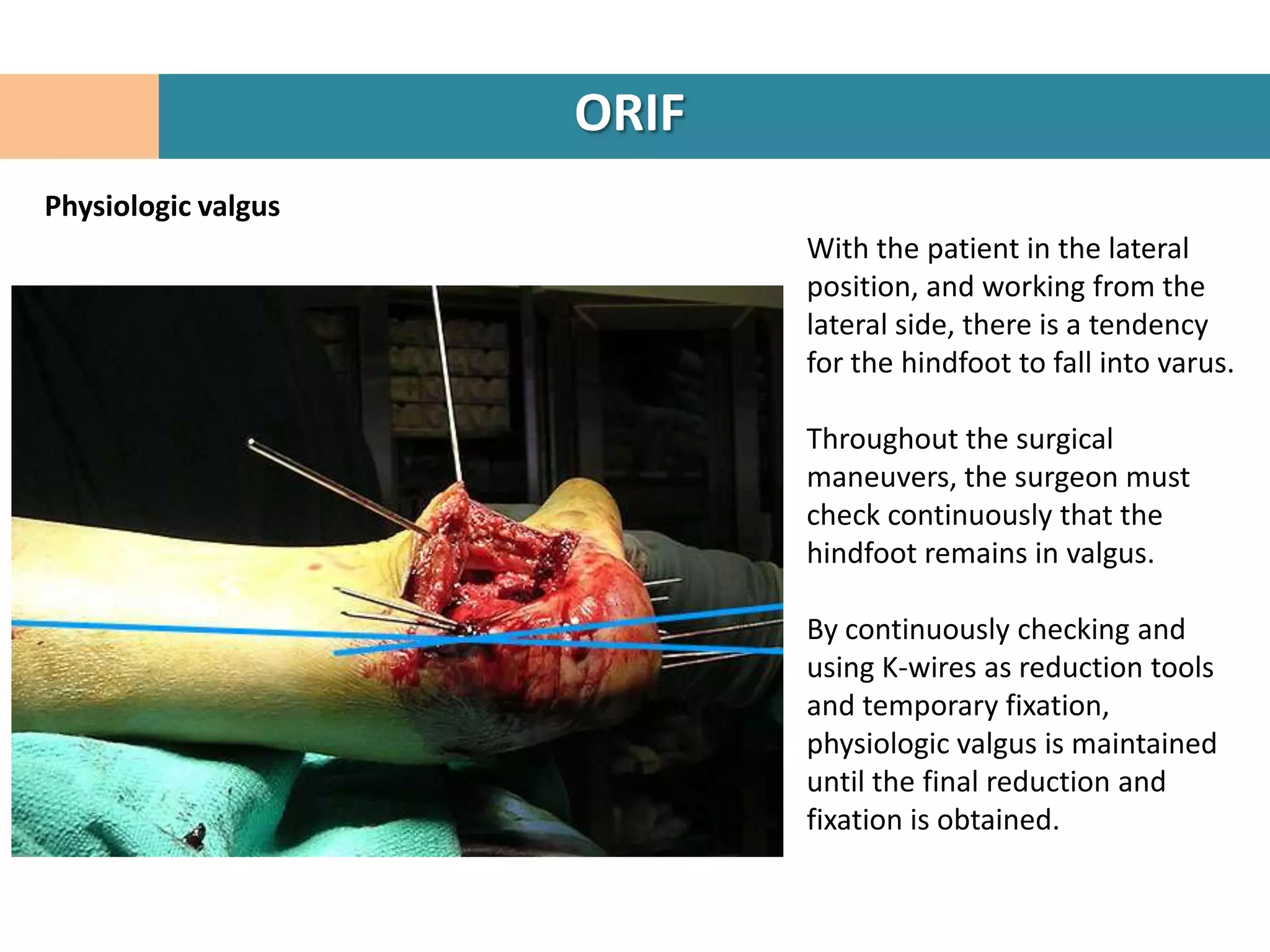 ORIF
Physiologic valgus
                            With the patient in the lateral
                            position, and working from the
                            lateral side, there is a tendency
                            for the hindfoot to fall into varus.

                            Throughout the surgical
                            maneuvers, the surgeon must
                            check continuously that the
                            hindfoot remains in valgus.

                            By continuously checking and
                            using K-wires as reduction tools
                            and temporary fixation,
                            physiologic valgus is maintained
                            until the final reduction and
                            fixation is obtained.
 
