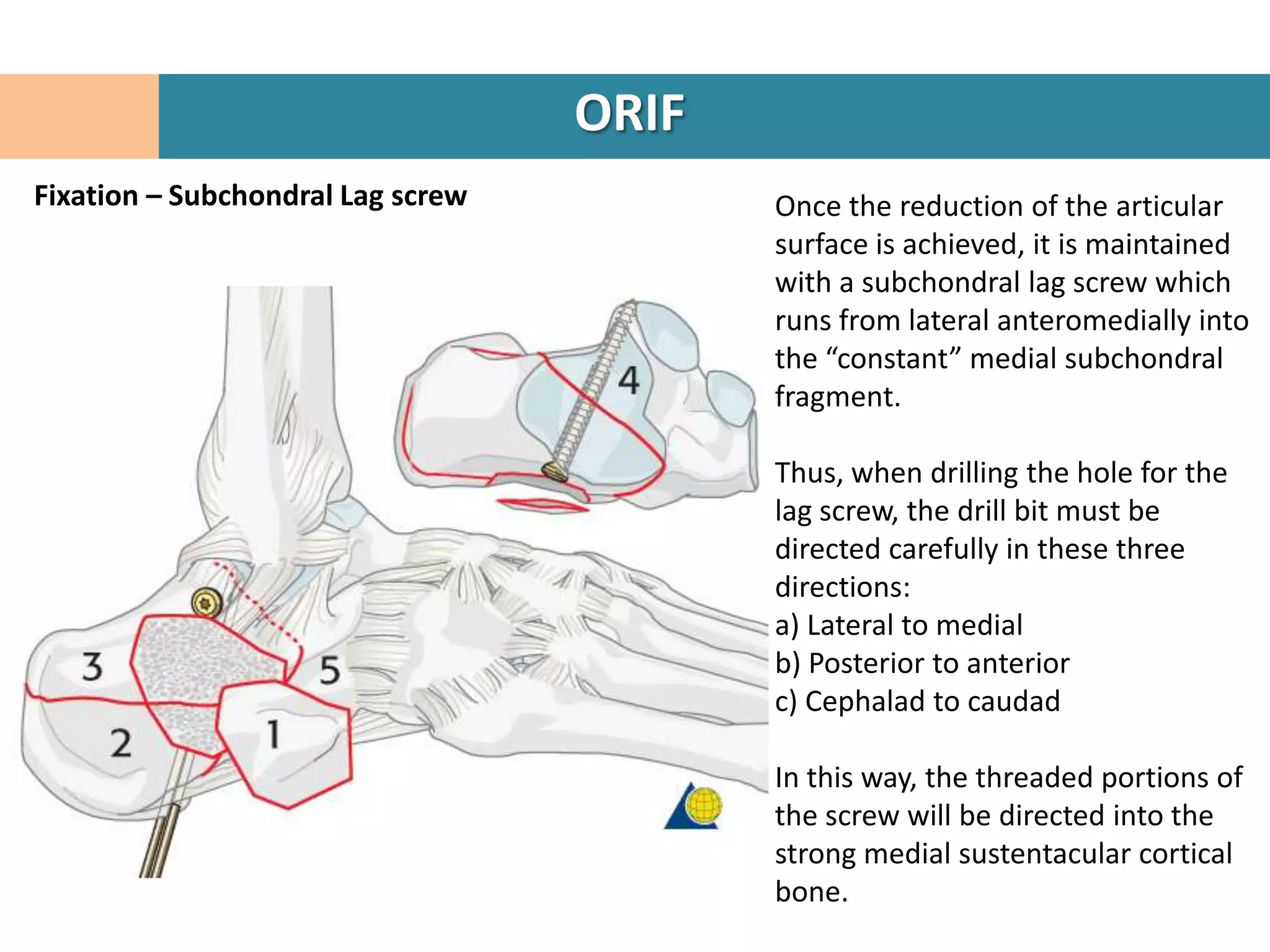 ORIF
Fixation – Subchondral Lag screw          Once the reduction of the articular
                                          surface is achieved, it is maintained
                                          with a subchondral lag screw which
                                          runs from lateral anteromedially into
                                          the “constant” medial subchondral
                                          fragment.

                                          Thus, when drilling the hole for the
                                          lag screw, the drill bit must be
                                          directed carefully in these three
                                          directions:
                                          a) Lateral to medial
                                          b) Posterior to anterior
                                          c) Cephalad to caudad

                                          In this way, the threaded portions of
                                          the screw will be directed into the
                                          strong medial sustentacular cortical
                                          bone.
 