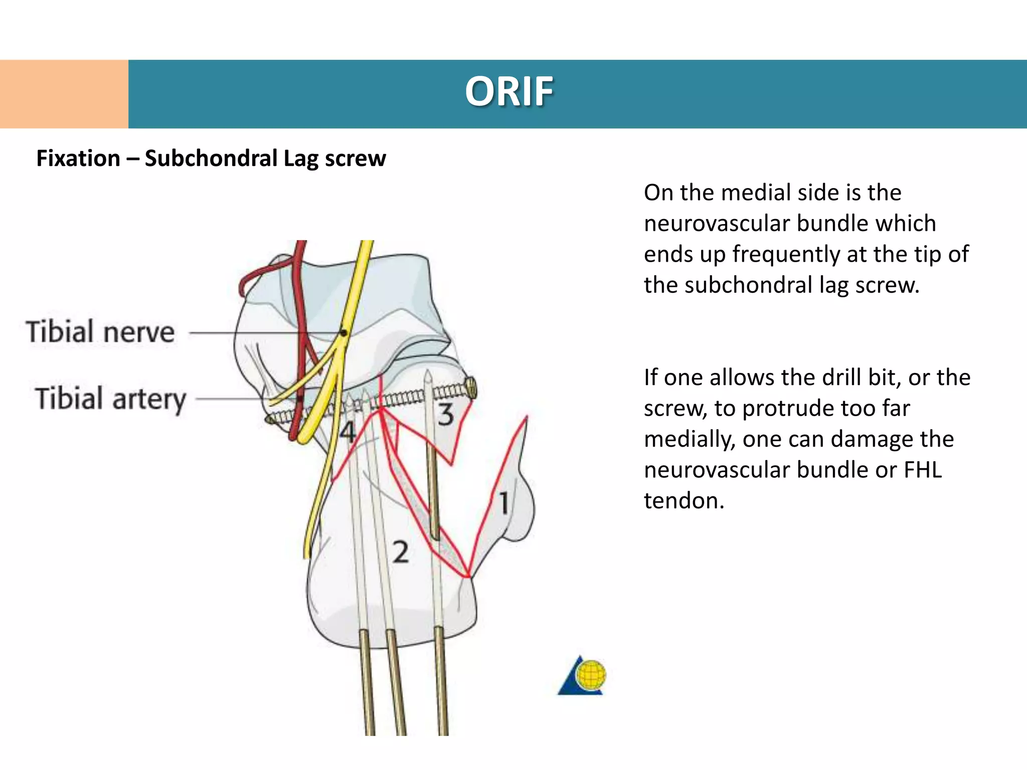 ORIF
Fixation – Subchondral Lag screw
                                          On the medial side is the
                                          neurovascular bundle which
                                          ends up frequently at the tip of
                                          the subchondral lag screw.


                                          If one allows the drill bit, or the
                                          screw, to protrude too far
                                          medially, one can damage the
                                          neurovascular bundle or FHL
                                          tendon.
 