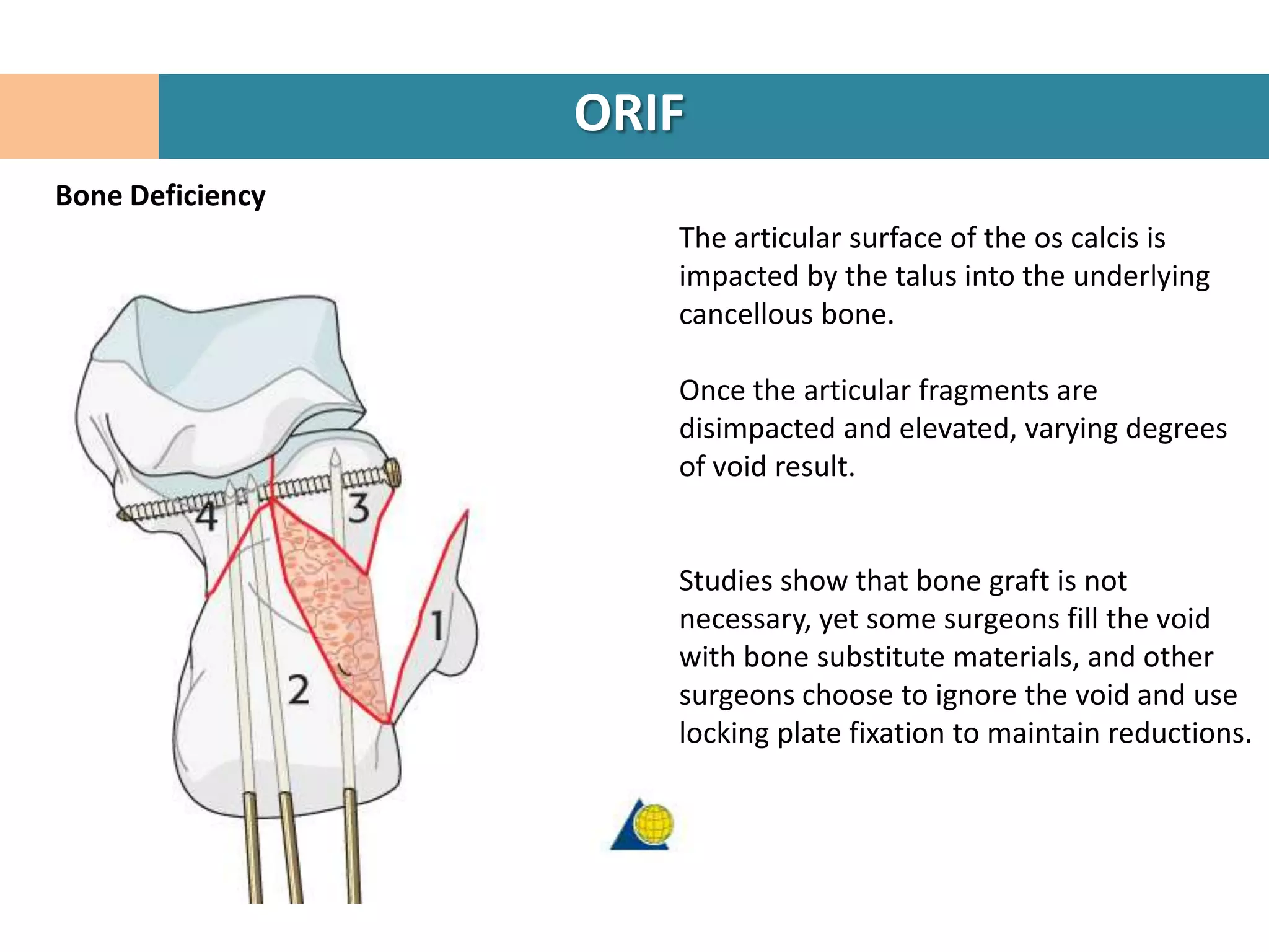 ORIF
Bone Deficiency
                     The articular surface of the os calcis is
                     impacted by the talus into the underlying
                     cancellous bone.

                     Once the articular fragments are
                     disimpacted and elevated, varying degrees
                     of void result.


                     Studies show that bone graft is not
                     necessary, yet some surgeons fill the void
                     with bone substitute materials, and other
                     surgeons choose to ignore the void and use
                     locking plate fixation to maintain reductions.
 