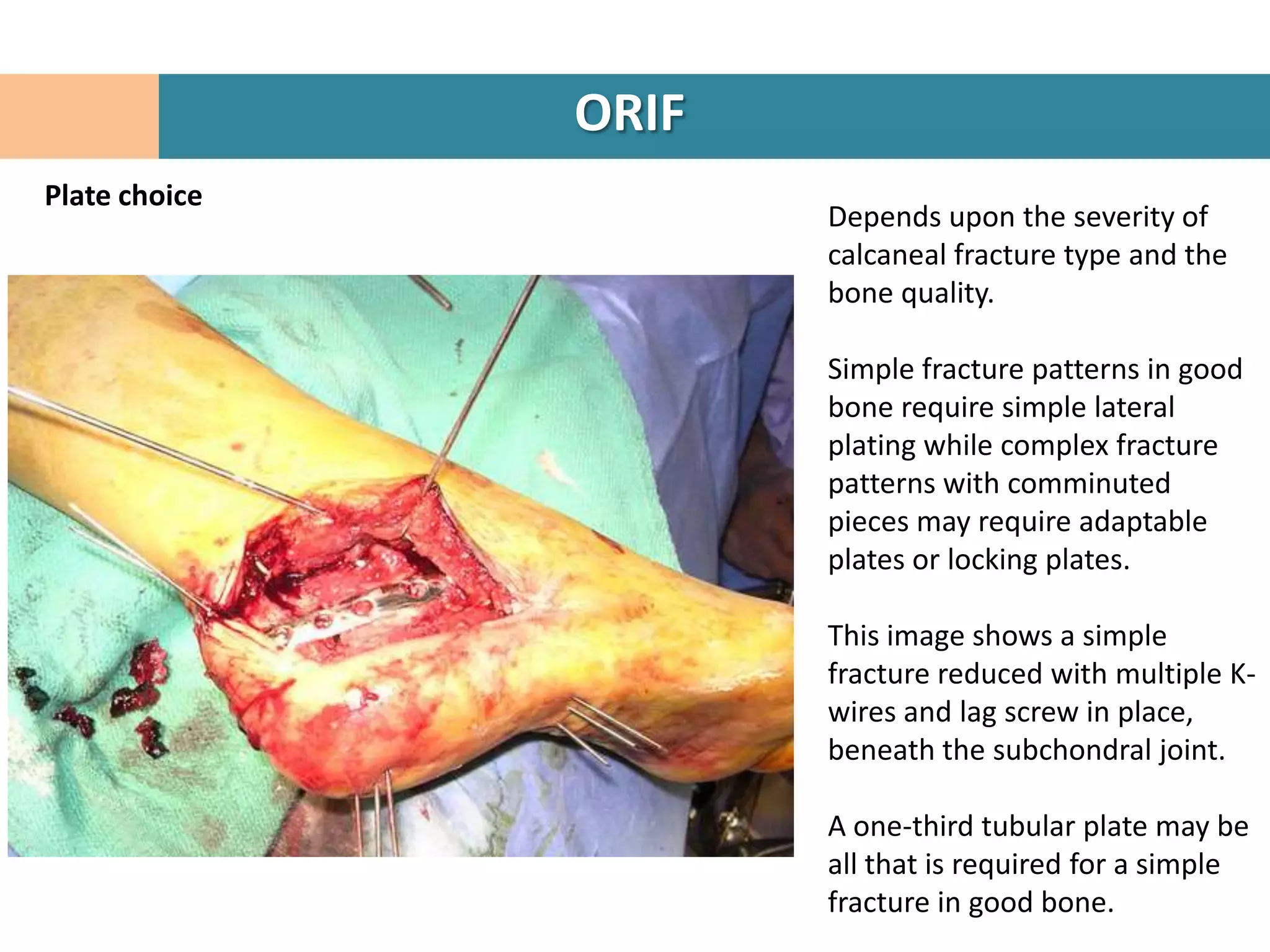 ORIF
Plate choice
                      Depends upon the severity of
                      calcaneal fracture type and the
                      bone quality.

                      Simple fracture patterns in good
                      bone require simple lateral
                      plating while complex fracture
                      patterns with comminuted
                      pieces may require adaptable
                      plates or locking plates.

                      This image shows a simple
                      fracture reduced with multiple K-
                      wires and lag screw in place,
                      beneath the subchondral joint.

                      A one-third tubular plate may be
                      all that is required for a simple
                      fracture in good bone.
 