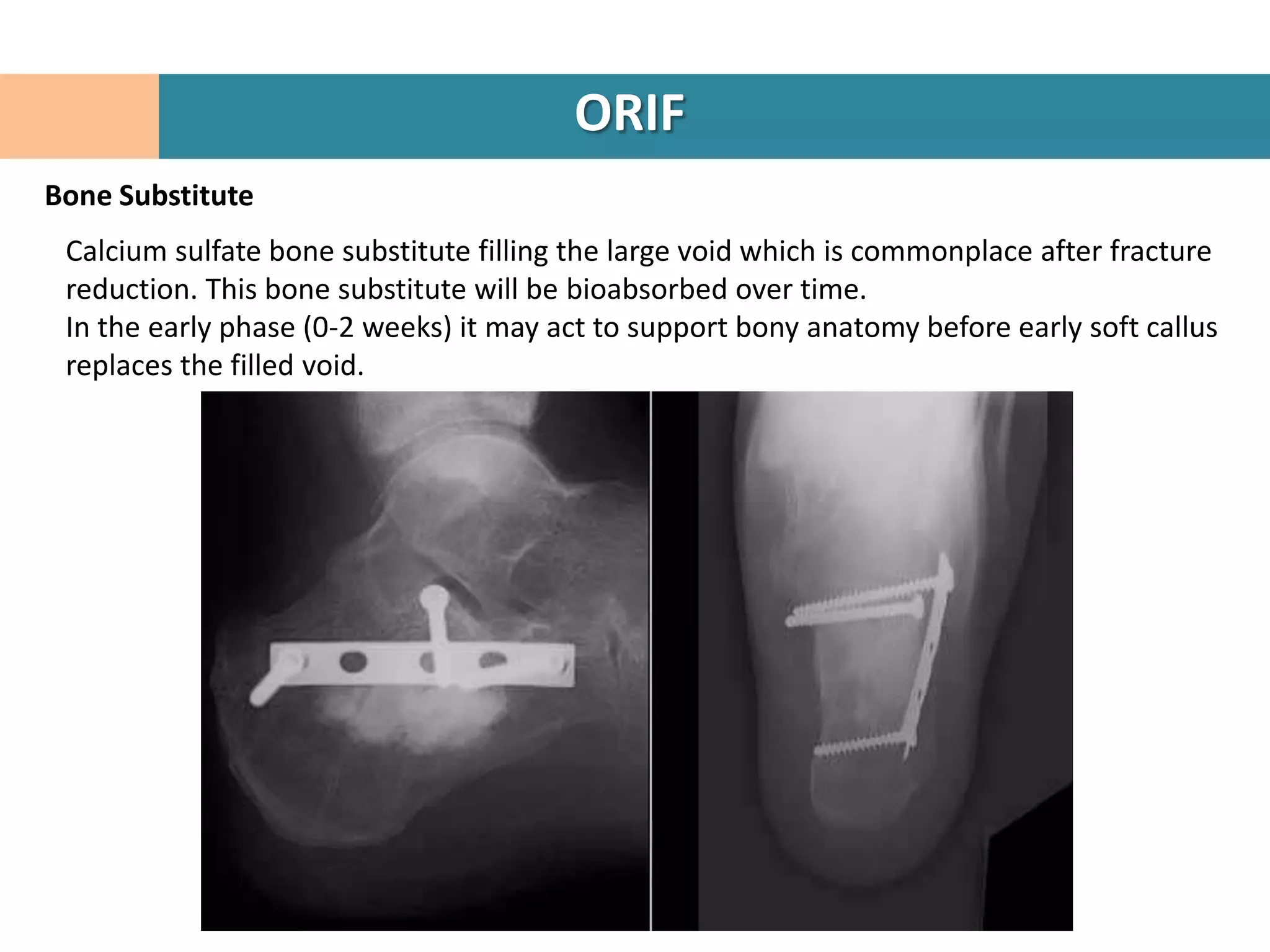 ORIF
Bone Substitute
 Calcium sulfate bone substitute filling the large void which is commonplace after fracture
 reduction. This bone substitute will be bioabsorbed over time.
 In the early phase (0-2 weeks) it may act to support bony anatomy before early soft callus
 replaces the filled void.
 