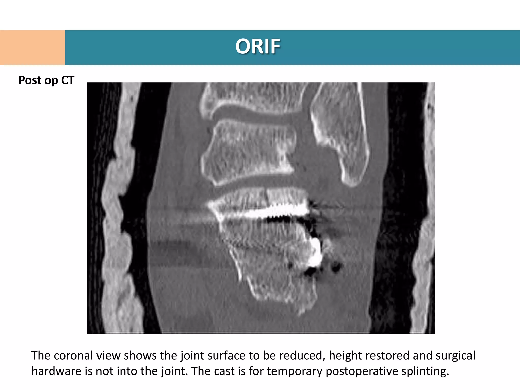 ORIF
Post op CT




  The coronal view shows the joint surface to be reduced, height restored and surgical
  hardware is not into the joint. The cast is for temporary postoperative splinting.
 