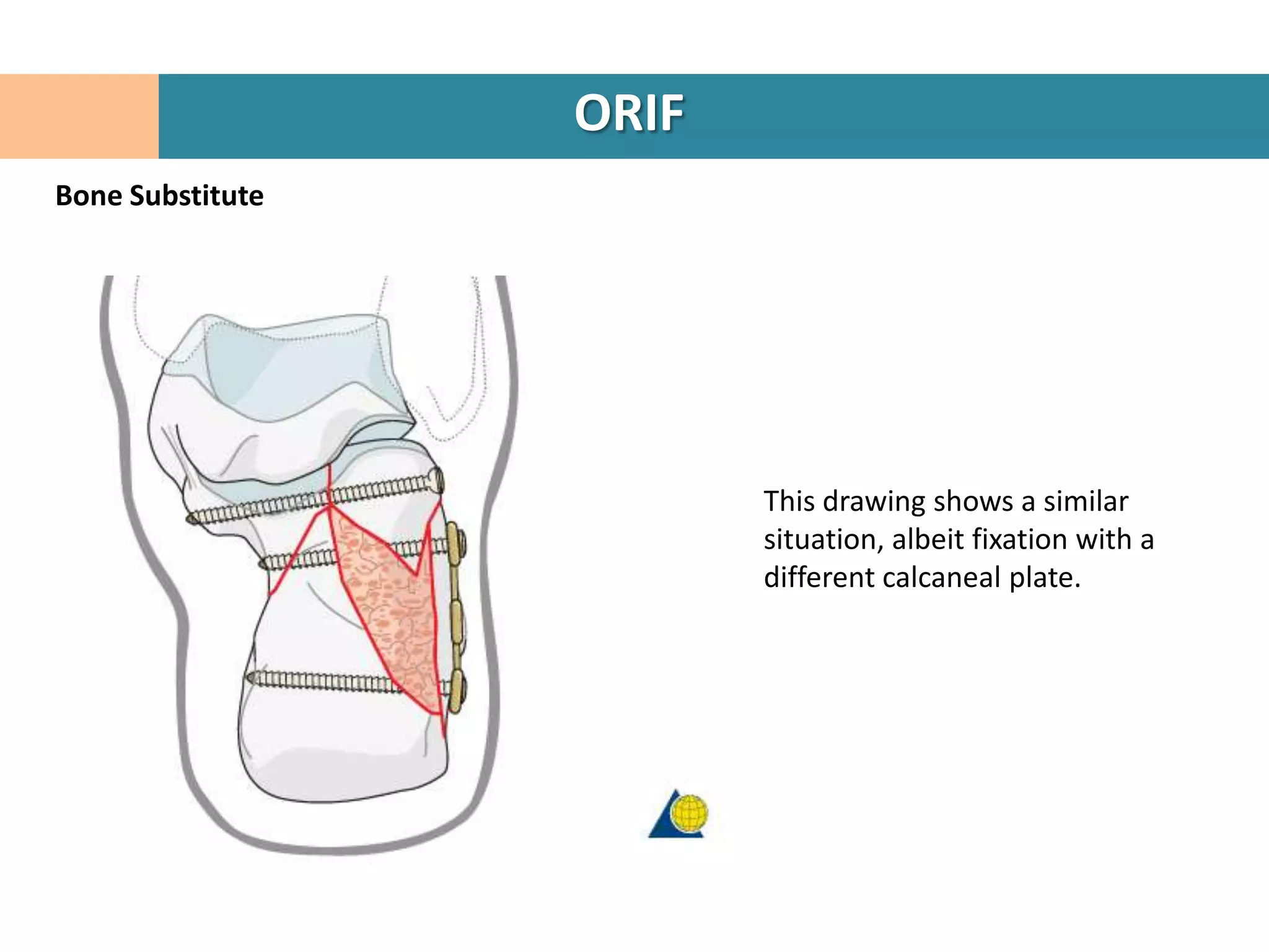 ORIF
Bone Substitute




                         This drawing shows a similar
                         situation, albeit fixation with a
                         different calcaneal plate.
 