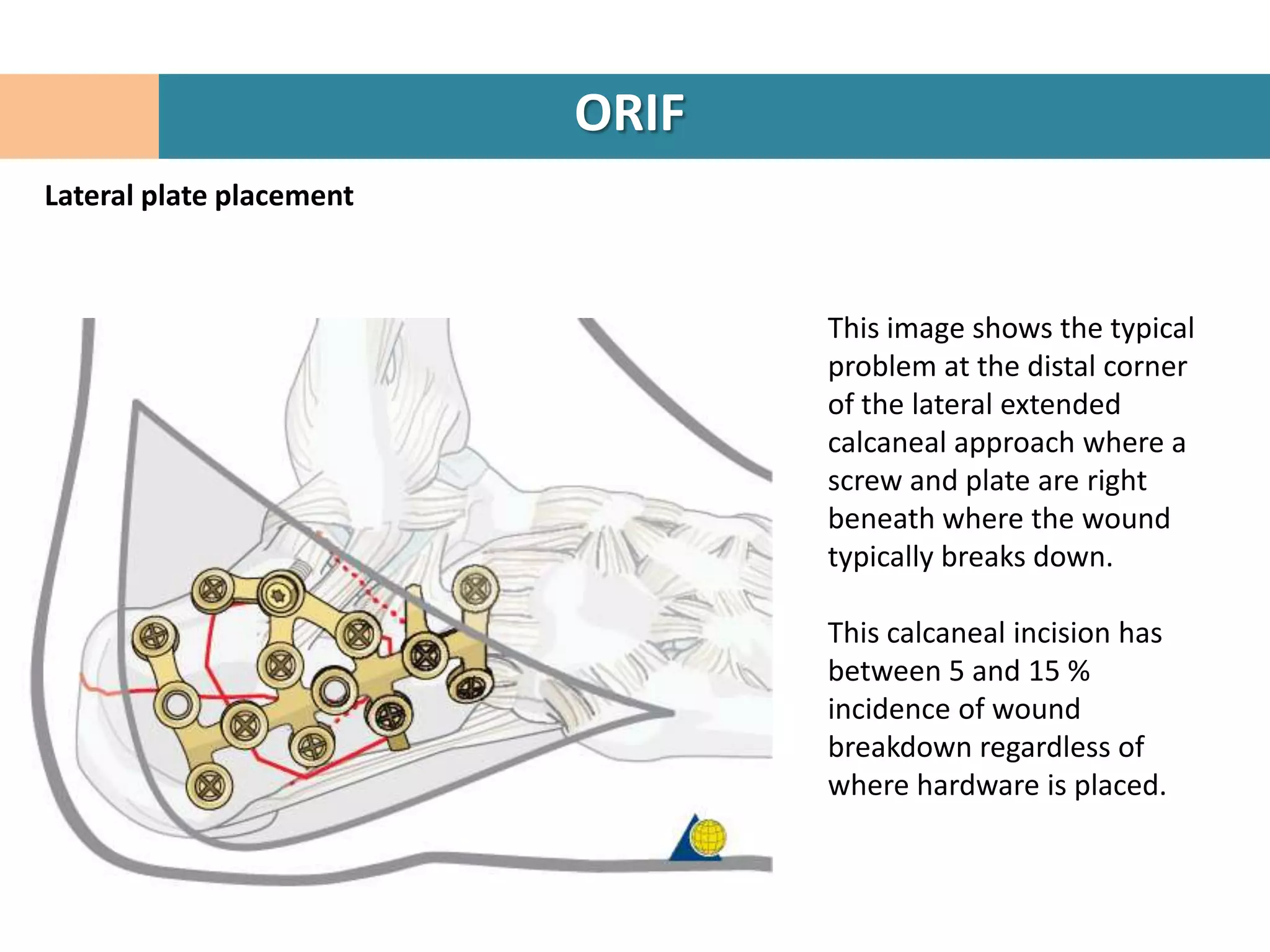 ORIF
Lateral plate placement



                                 This image shows the typical
                                 problem at the distal corner
                                 of the lateral extended
                                 calcaneal approach where a
                                 screw and plate are right
                                 beneath where the wound
                                 typically breaks down.

                                 This calcaneal incision has
                                 between 5 and 15 %
                                 incidence of wound
                                 breakdown regardless of
                                 where hardware is placed.
 