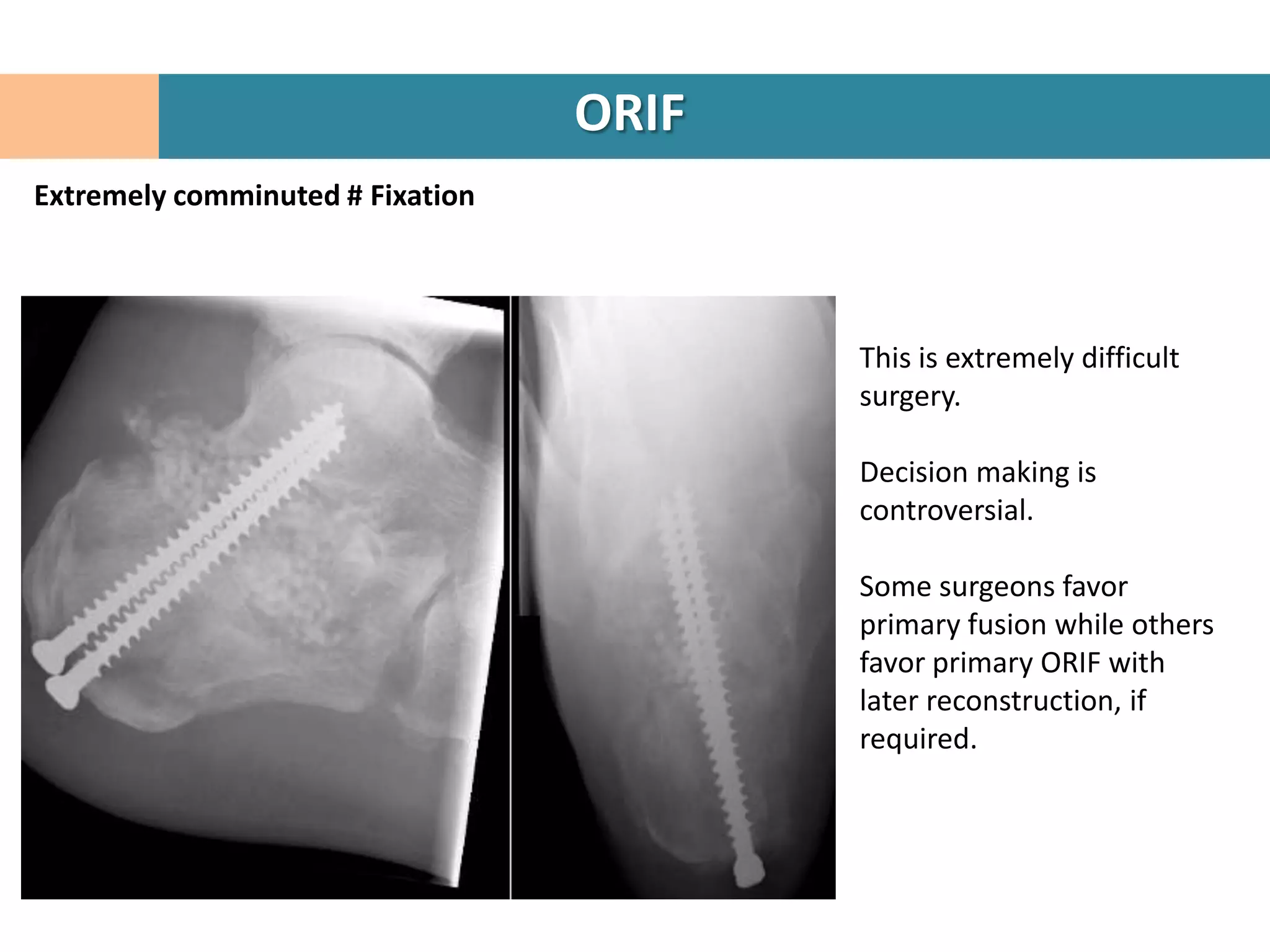 ORIF
Extremely comminuted # Fixation




                                         This is extremely difficult
                                         surgery.

                                         Decision making is
                                         controversial.

                                         Some surgeons favor
                                         primary fusion while others
                                         favor primary ORIF with
                                         later reconstruction, if
                                         required.
 
