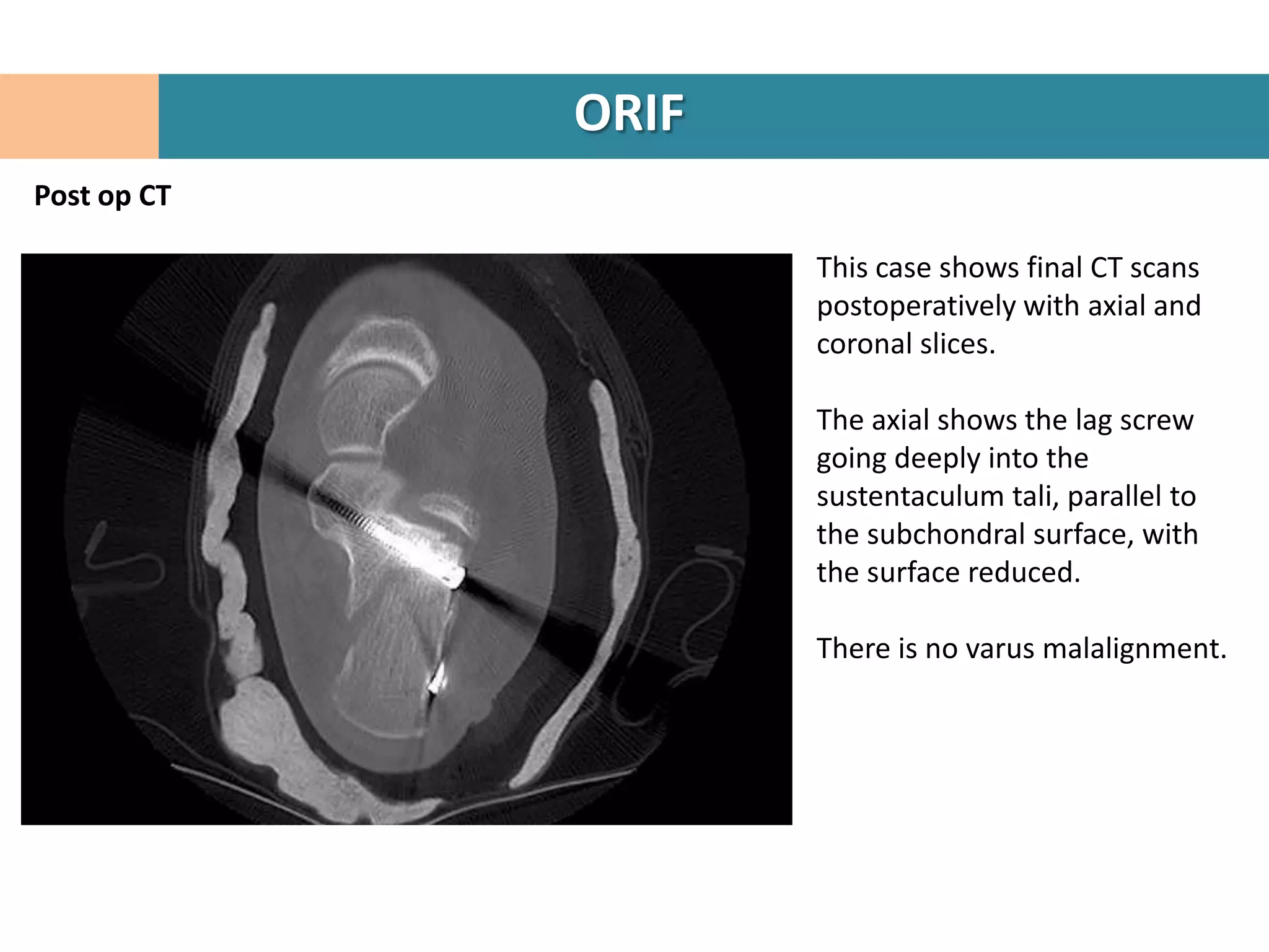 ORIF
Post op CT

                    This case shows final CT scans
                    postoperatively with axial and
                    coronal slices.

                    The axial shows the lag screw
                    going deeply into the
                    sustentaculum tali, parallel to
                    the subchondral surface, with
                    the surface reduced.

                    There is no varus malalignment.
 