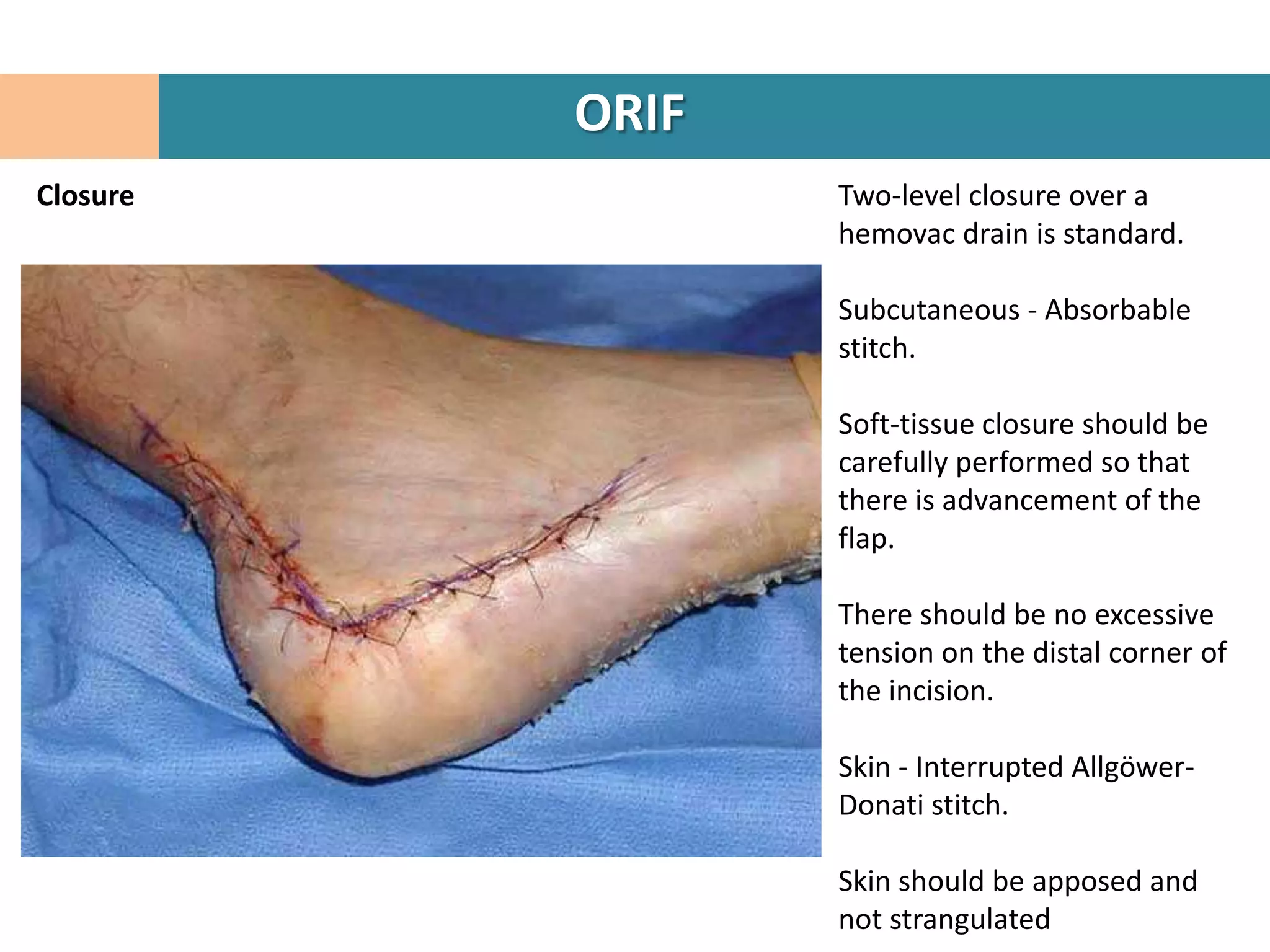 ORIF
Closure          Two-level closure over a
                 hemovac drain is standard.

                 Subcutaneous - Absorbable
                 stitch.

                 Soft-tissue closure should be
                 carefully performed so that
                 there is advancement of the
                 flap.

                 There should be no excessive
                 tension on the distal corner of
                 the incision.

                 Skin - Interrupted Allgöwer-
                 Donati stitch.

                 Skin should be apposed and
                 not strangulated
 