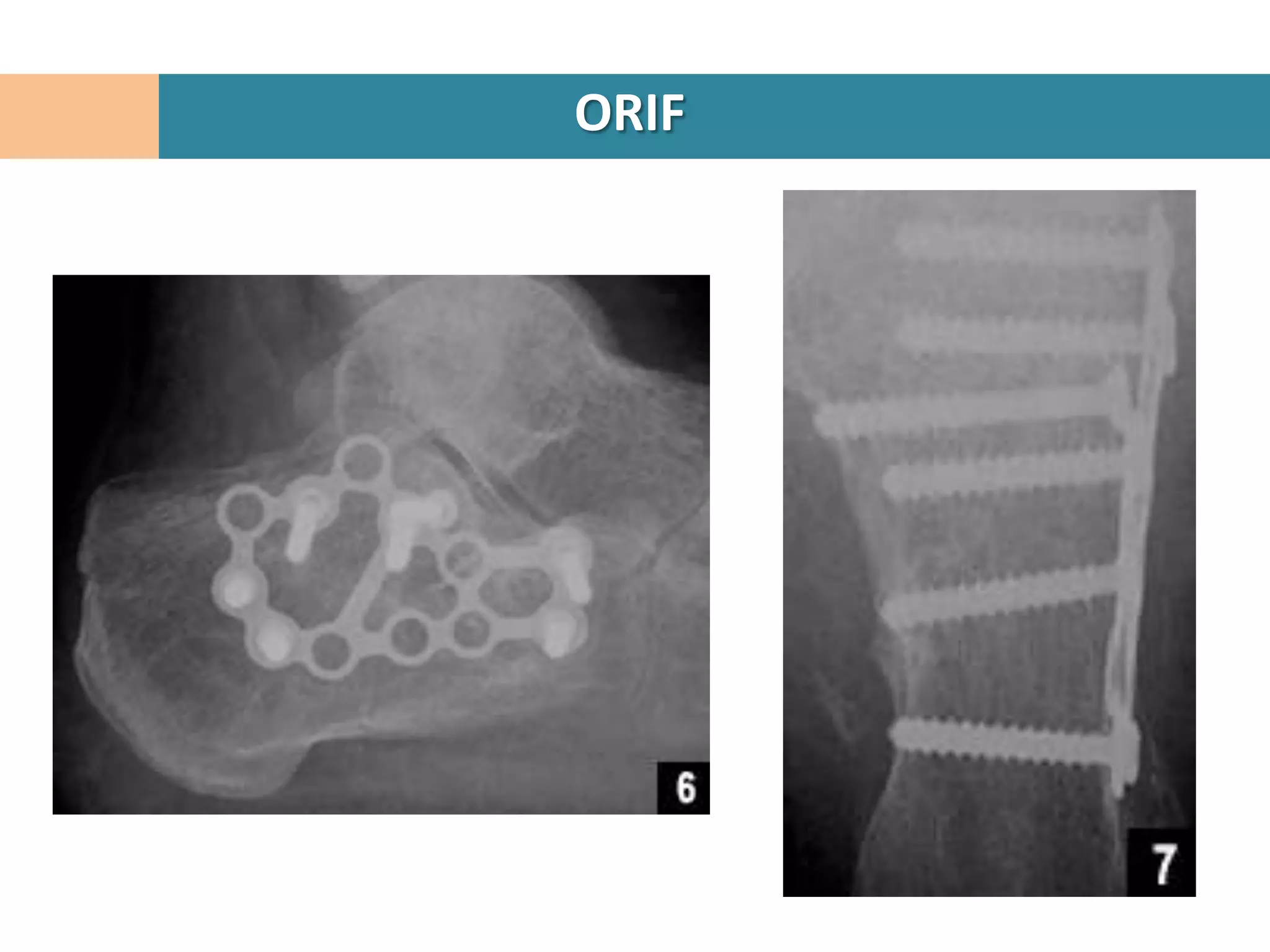 ORIF
 
