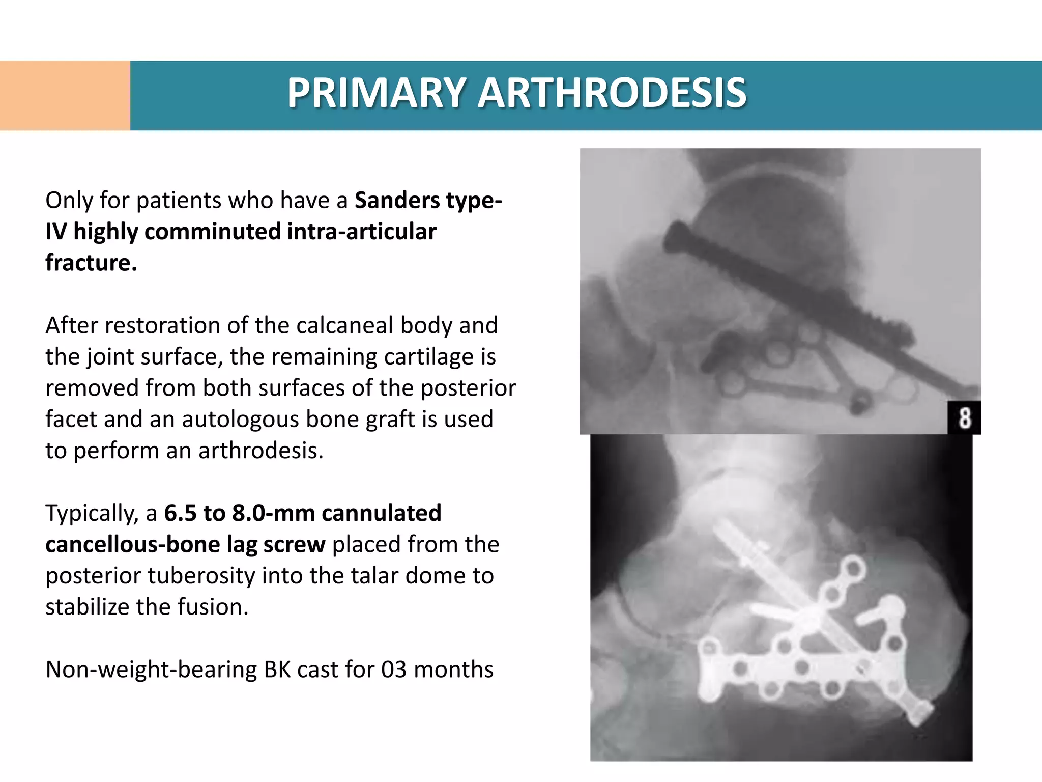 PRIMARY ARTHRODESIS

Only for patients who have a Sanders type-
IV highly comminuted intra-articular
fracture.

After restoration of the calcaneal body and
the joint surface, the remaining cartilage is
removed from both surfaces of the posterior
facet and an autologous bone graft is used
to perform an arthrodesis.

Typically, a 6.5 to 8.0-mm cannulated
cancellous-bone lag screw placed from the
posterior tuberosity into the talar dome to
stabilize the fusion.

Non-weight-bearing BK cast for 03 months
 
