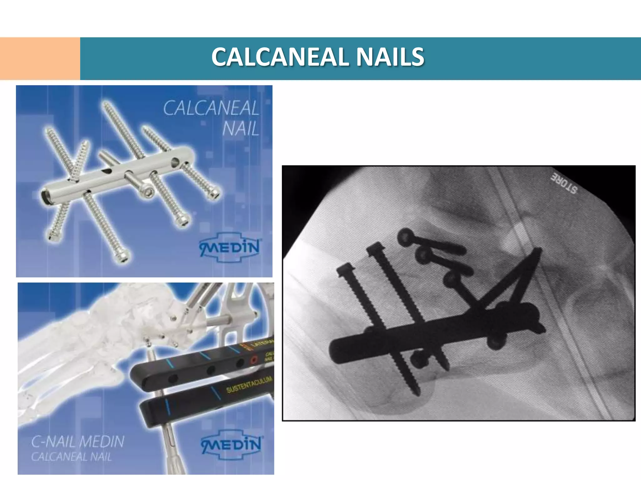 CALCANEAL NAILS
 