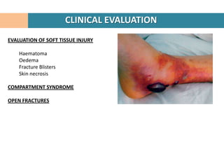 CLINICAL EVALUATION
EVALUATION OF SOFT TISSUE INJURY

    Haematoma
    Oedema
    Fracture Blisters
    Skin necrosis

COMPARTMENT SYNDROME

OPEN FRACTURES
 