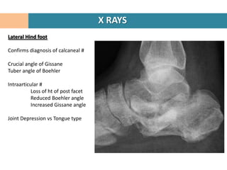 X RAYS
Lateral Hind foot

Confirms diagnosis of calcaneal #

Crucial angle of Gissane
Tuber angle of Boehler

Intraarticular #
           Loss of ht of post facet
           Reduced Boehler angle
           Increased Gissane angle

Joint Depression vs Tongue type
 