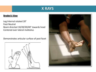 X RAYS
Broden’s View

Leg Internal rotated 20°
Foot Neutral
Beam directed 10/20/30/40° towards head
Centered over lateral malleolus


Demonstrates articular surface of post facet
 