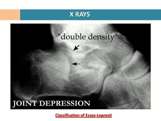 X RAYS




Classification of Essex-Lopresti
 