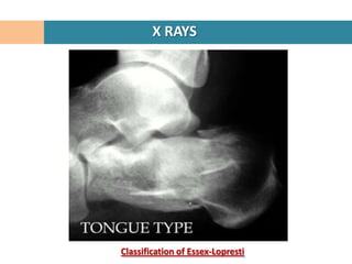 X RAYS




Classification of Essex-Lopresti
 