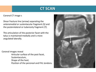 CT SCAN
 Coronal CT image s

 Shear fracture line (arrow) separating the
 anteromedial or sustentacular fragment (S) and
 the posterolateral or tuberosity fragment (T).

 The articulation of the posterior facet with the
 talus is maintained medially and is more
 angulated laterally.




Coronal images reveal
         Articular surface of the post facet,
         Sustentaculum,
         Shape of the heel,
         Position of the peroneal and FHL tendons.
 