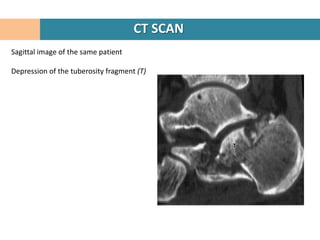 CT SCAN
Sagittal image of the same patient

Depression of the tuberosity fragment (T)
 