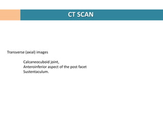 CT SCAN




Transverse (axial) images

         Calcaneocuboid joint,
         Anteroinferior aspect of the post facet
         Sustentaculum.
 