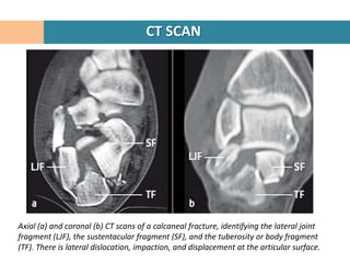 CT SCAN




Axial (a) and coronal (b) CT scans of a calcaneal fracture, identifying the lateral joint
fragment (LJF), the sustentacular fragment (SF), and the tuberosity or body fragment
(TF). There is lateral dislocation, impaction, and displacement at the articular surface.
 