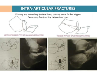 INTRA-ARTICULAR FRACTURES
Primary and secondary fracture lines, primary same for both types
            Secondary Fracture line determines type
 