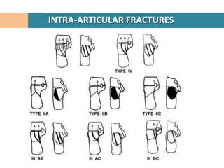 INTRA-ARTICULAR FRACTURES
 
