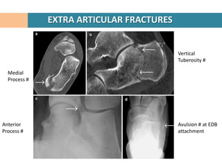 EXTRA ARTICULAR FRACTURES


                                          Vertical
                                          Tuberosity #

  Medial
  Process #




Anterior                                  Avulsion # at EDB
Process #                                 attachment
 