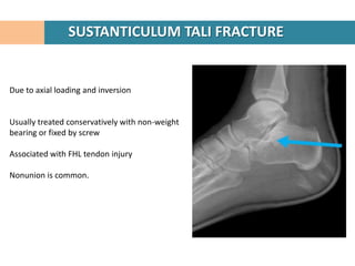 SUSTANTICULUM TALI FRACTURE


Due to axial loading and inversion


Usually treated conservatively with non-weight
bearing or fixed by screw

Associated with FHL tendon injury

Nonunion is common.
 
