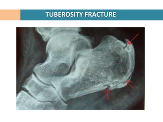 TUBEROSITY FRACTURE
 