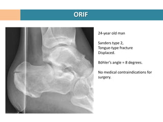 ORIF

       24-year old man

       Sanders type 2,
       Tongue-type fracture
       Displaced.

       Böhler’s angle = 8 degrees.

       No medical contraindications for
       surgery.
 