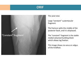 ORIF

       The axial view

       Large “constant” sustentacular
       fragment.

       The fracture splits the middle of the
       posterior facet, and it is displaced.

       The “constant” fragment is the stable
       medial calcaneal building block
       which allows lag fixation.

       This image shows no varus or valgus
       of the hindfoot.
 
