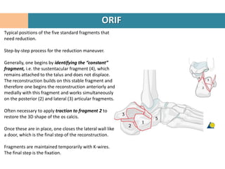 ORIF
Typical positions of the five standard fragments that
need reduction.

Step-by-step process for the reduction maneuver.

Generally, one begins by identifying the “constant”
fragment, i.e. the sustentacular fragment (4), which
remains attached to the talus and does not displace.
The reconstruction builds on this stable fragment and
therefore one begins the reconstruction anteriorly and
medially with this fragment and works simultaneously
on the posterior (2) and lateral (3) articular fragments.

Often necessary to apply traction to fragment 2 to
restore the 3D shape of the os calcis.

Once these are in place, one closes the lateral wall like
a door, which is the final step of the reconstruction.

Fragments are maintained temporarily with K-wires.
The final step is the fixation.
 